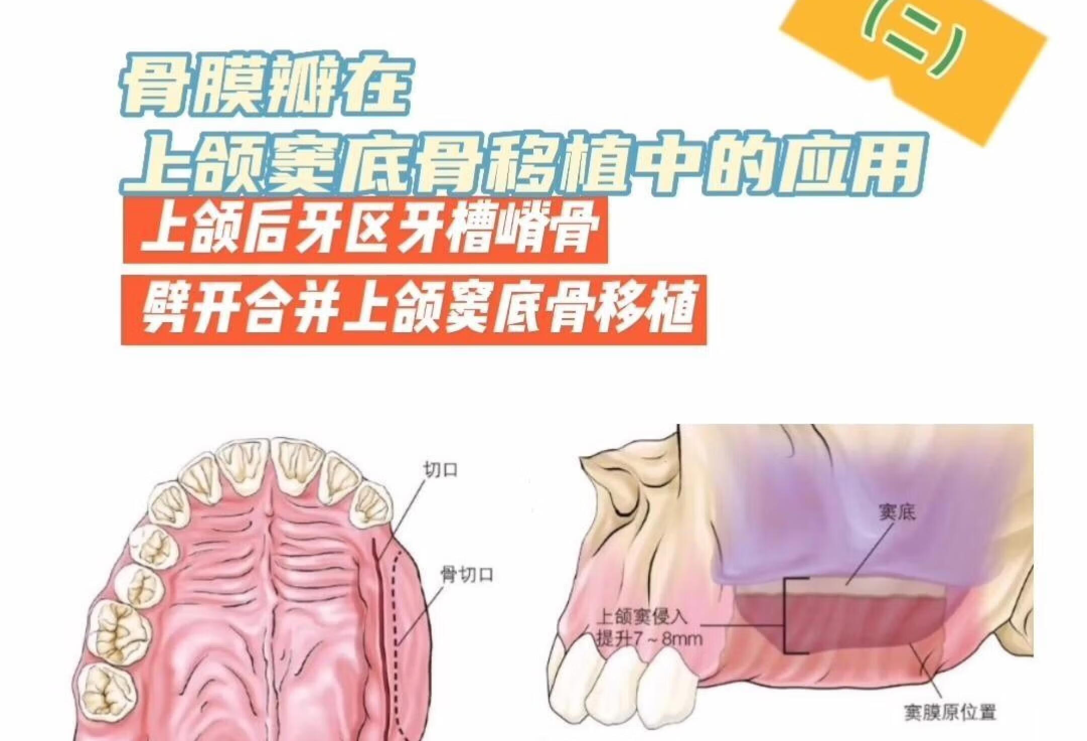 骨膜瓣在上颌窦底骨移植中的应用(二)