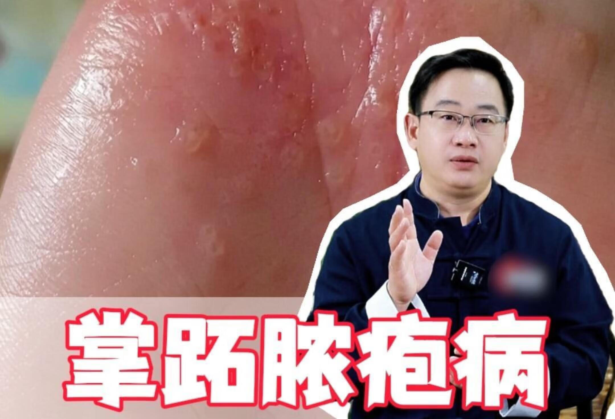 掌跖脓疱寎，可以恢复吗？