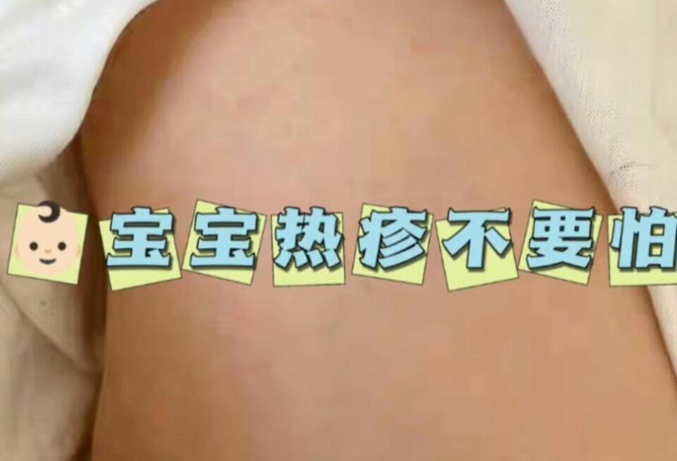 宝宝热疹别怕！我来教你轻松应对！