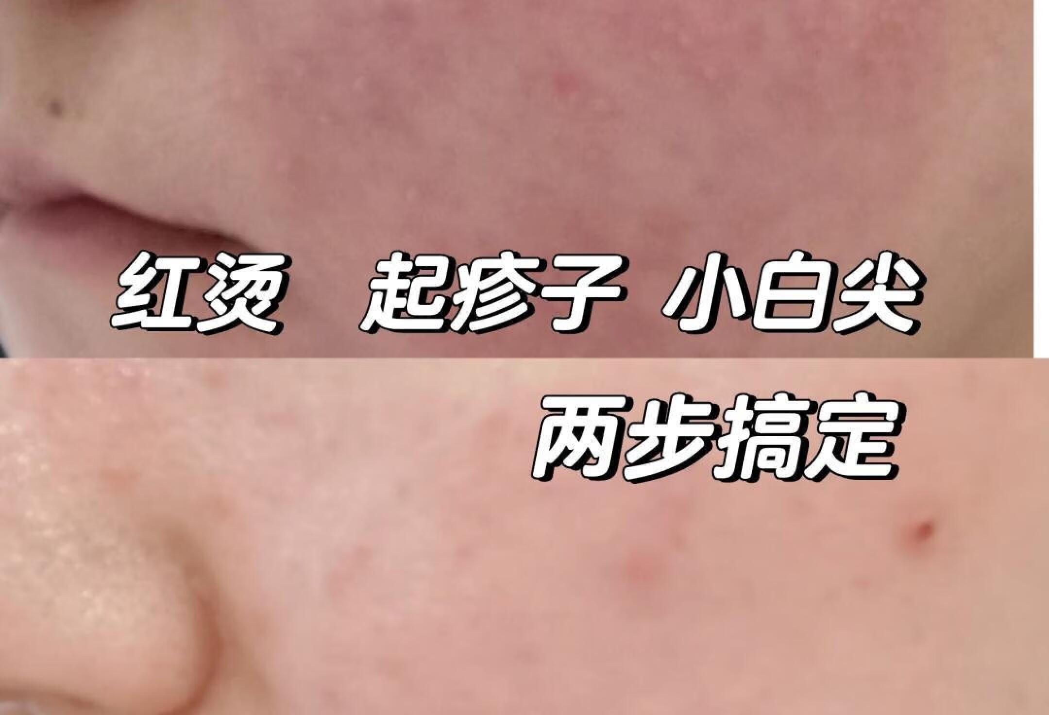 红烫小疹子，冒白尖2步搞定