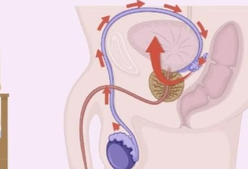 逆行射精症如何治疗?
