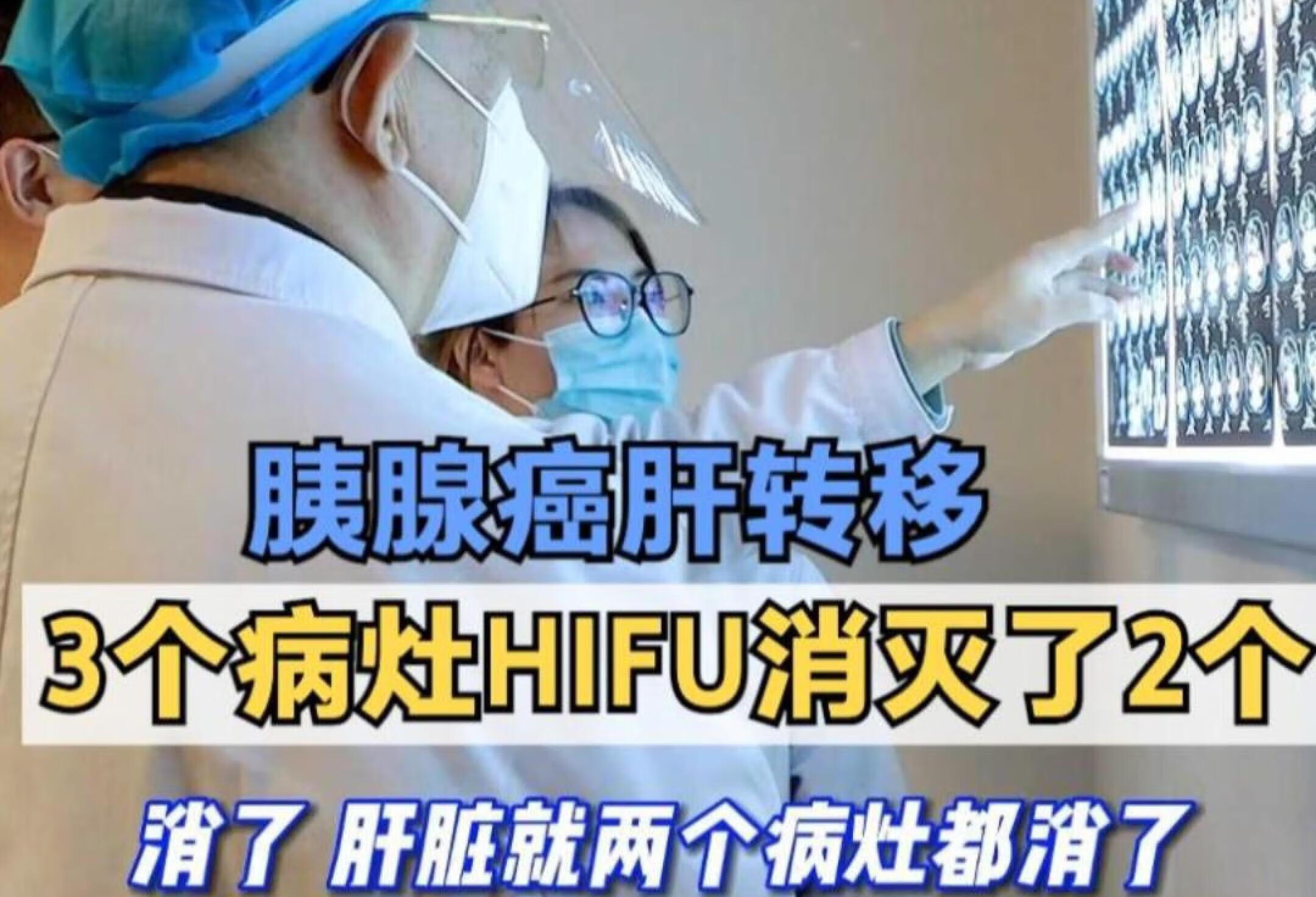 胰腺癌肝转移，3个病灶HIFU消灭2个！