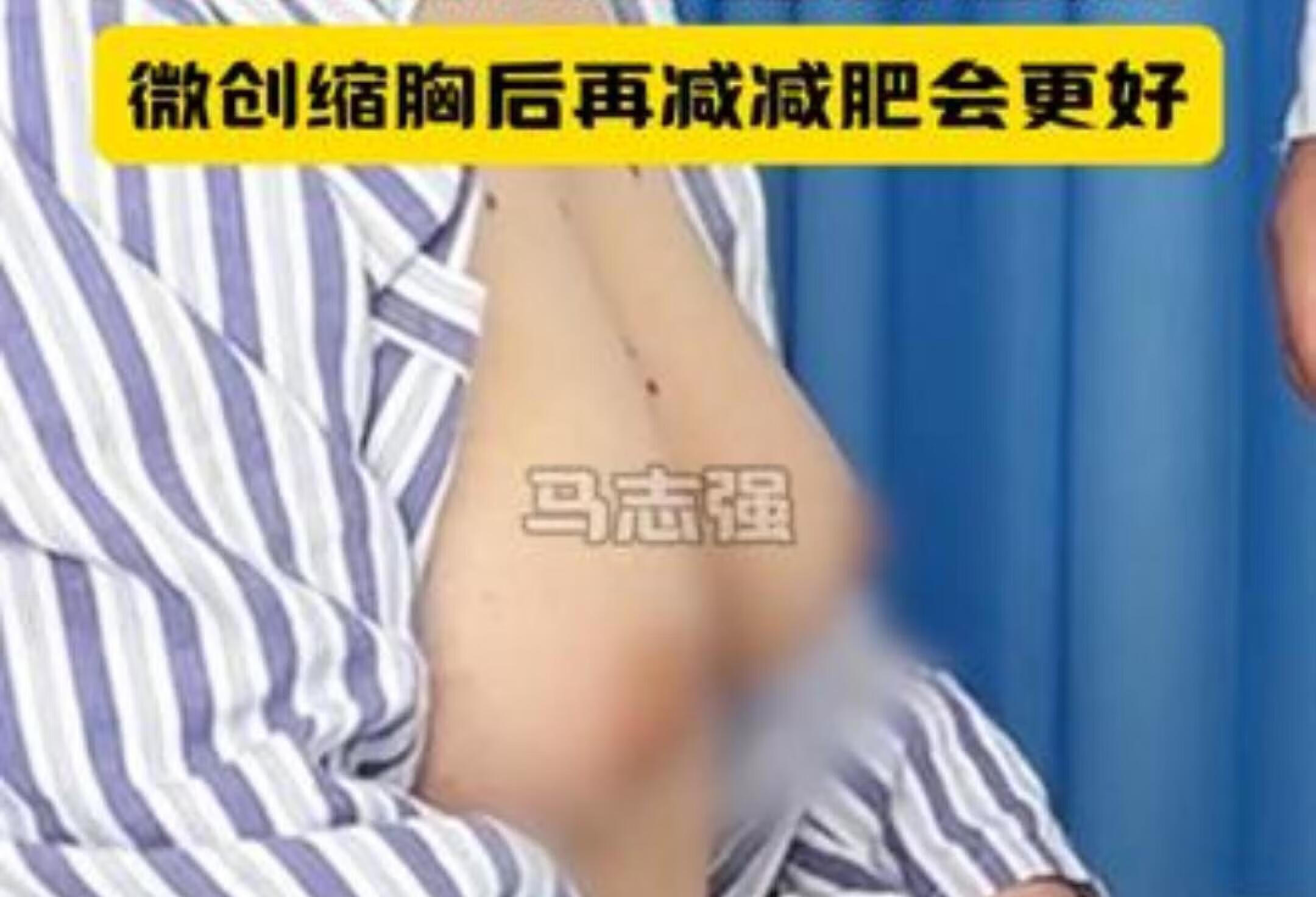 男乳发育症门诊日常解密