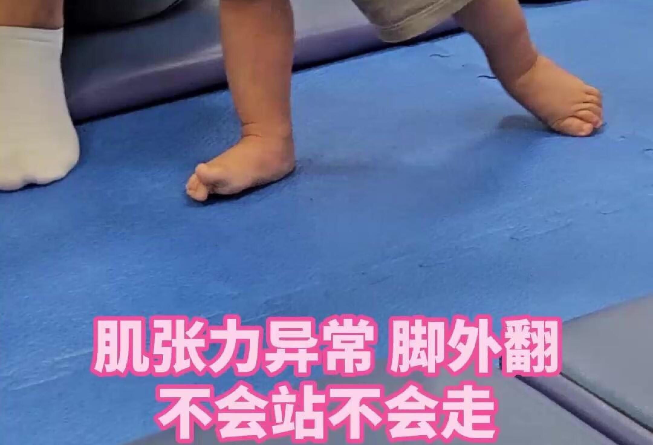 孩子肌张力异常脚外翻，不会站立不会走