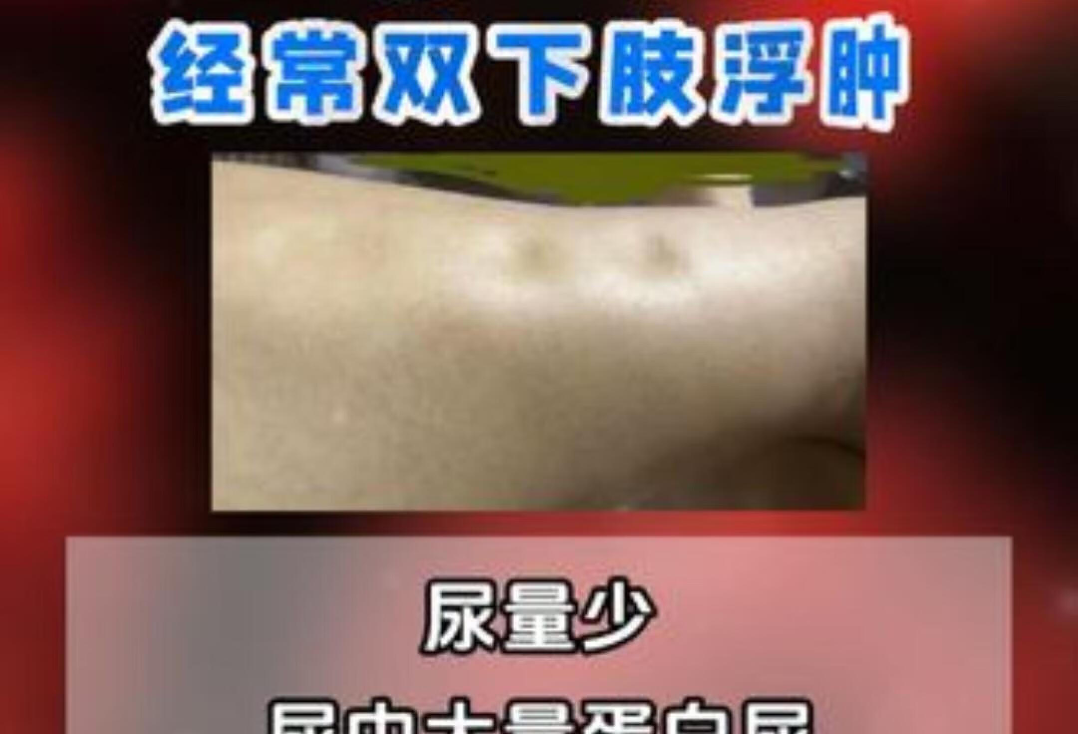 30岁女子患慢性肾炎，专家解读