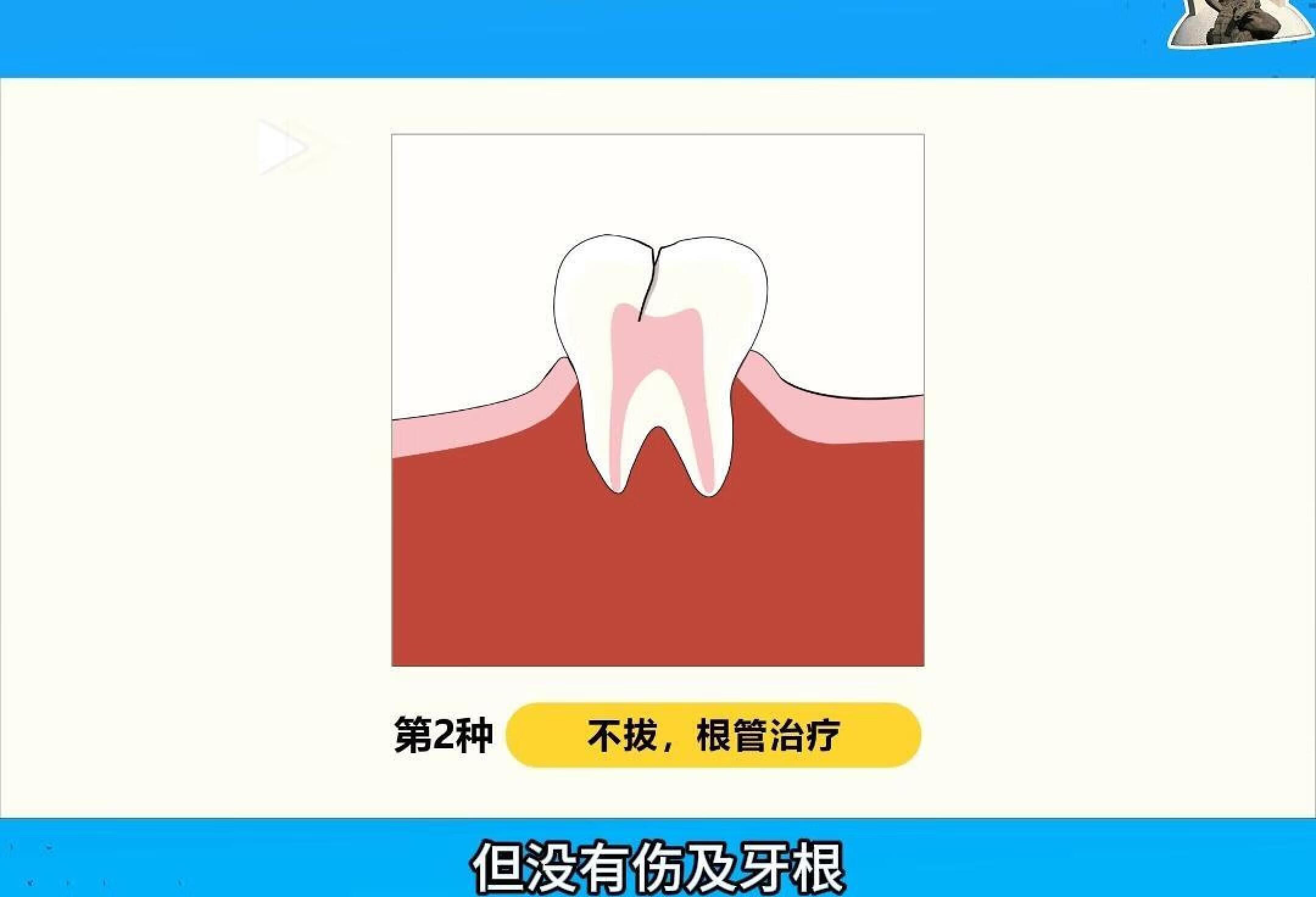 牙齿劈裂需要拔掉吗?