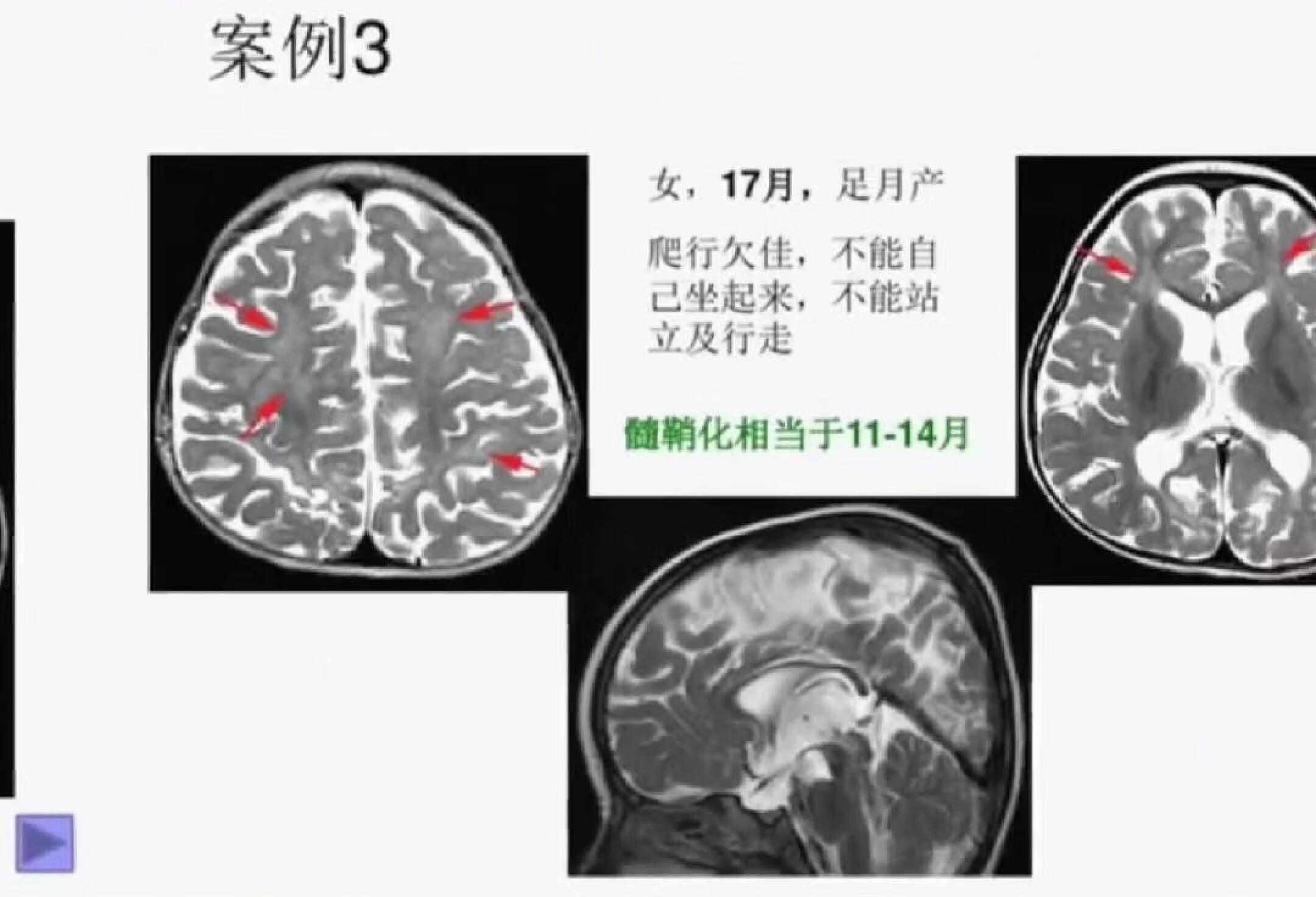 核磁显示髓鞘化延迟和发育不良的来学学