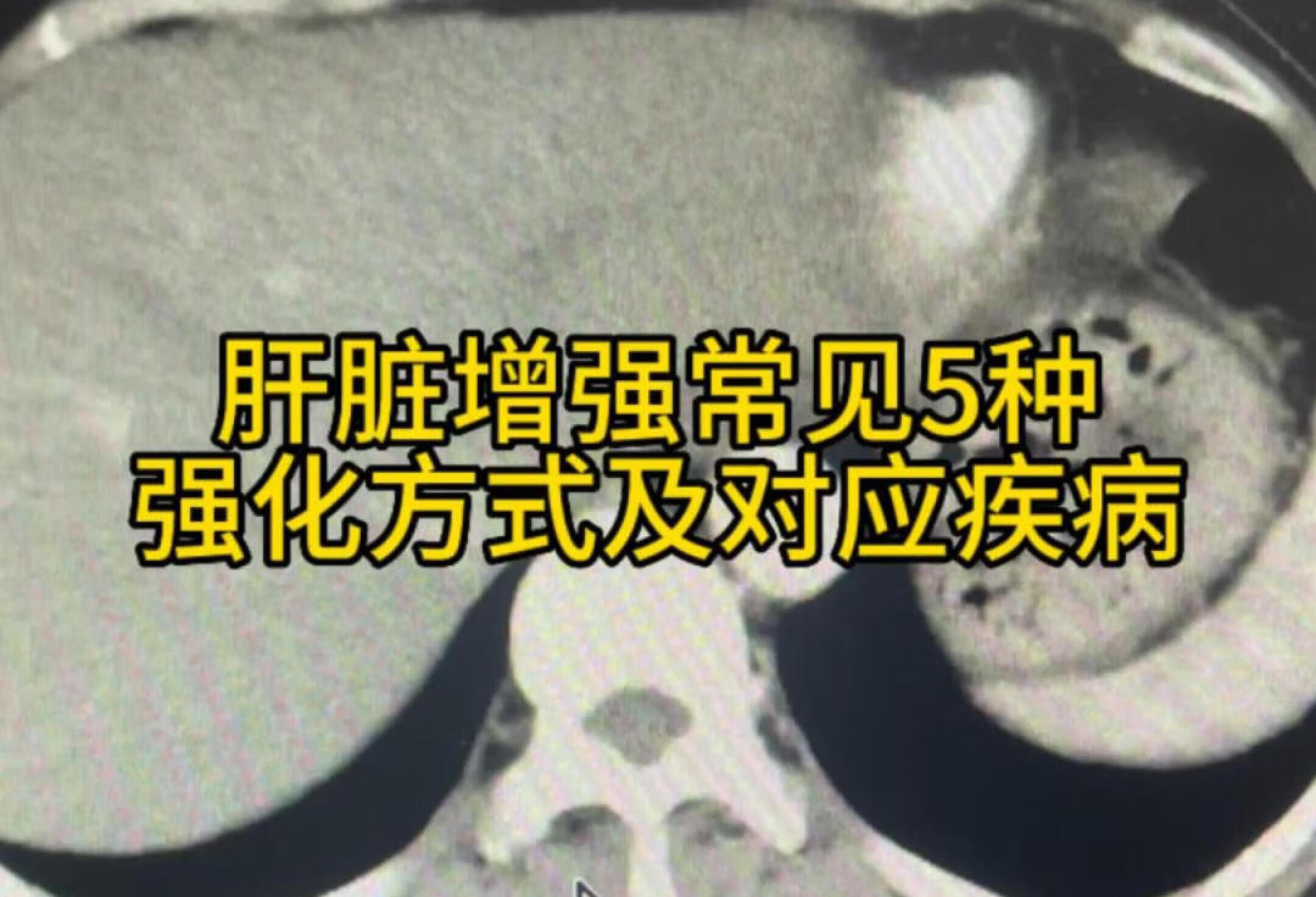 肝脏增强常见5种强化方式及对应疾病影像学