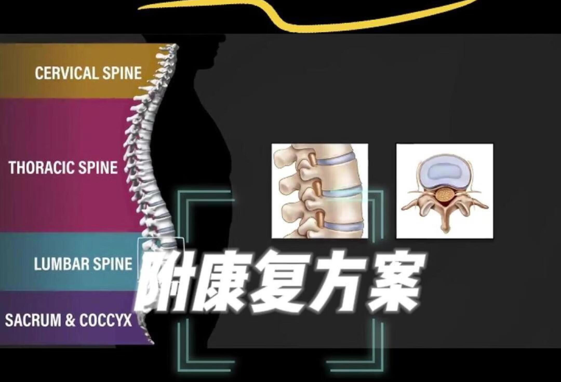 椎管狭窄