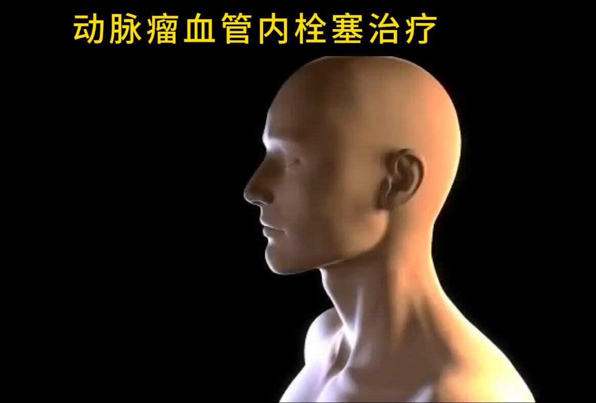 3D动画演示，动脉瘤血管内栓塞治疗