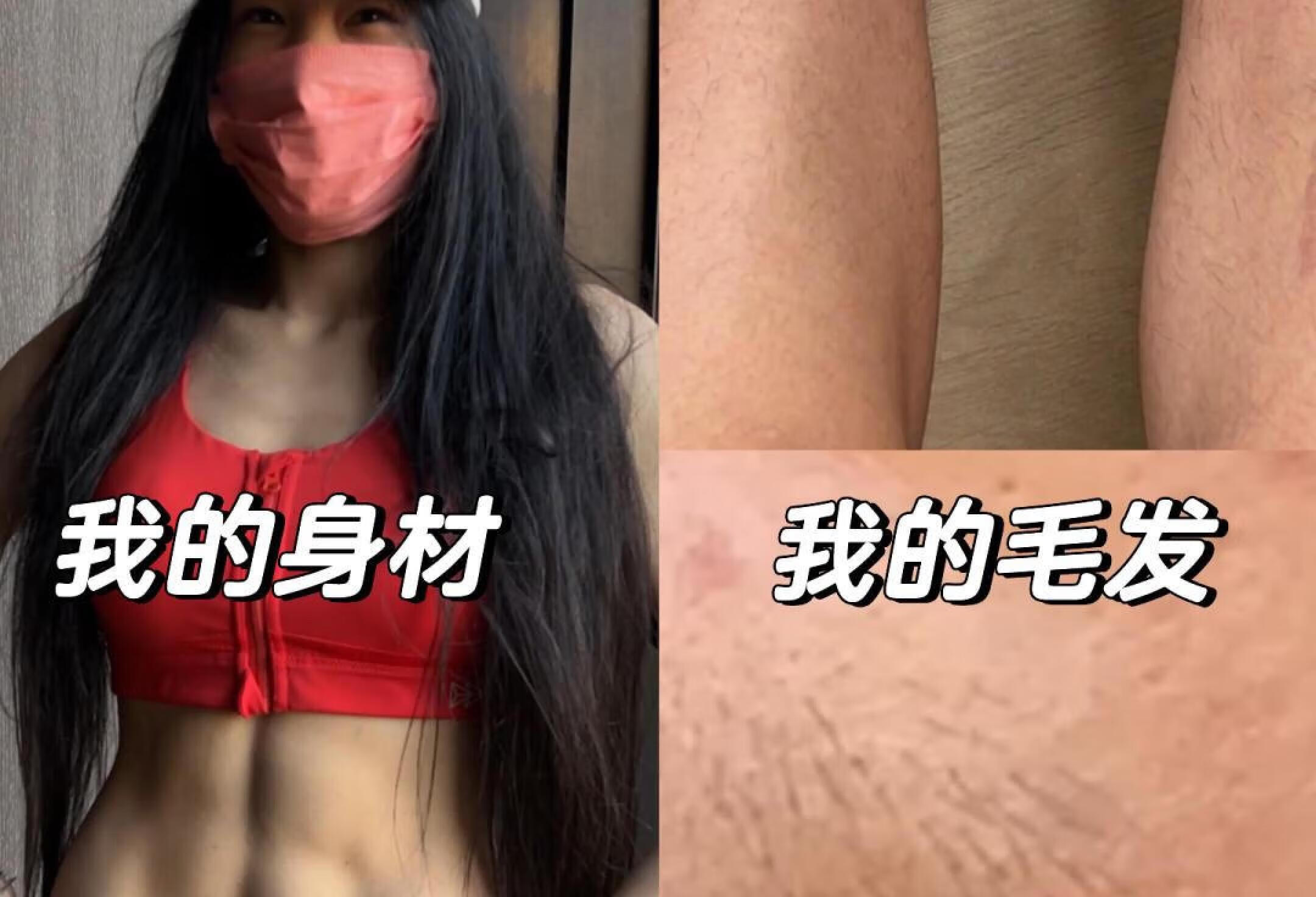 保持三年腹肌的痘痘脸女生雄激素高吗？