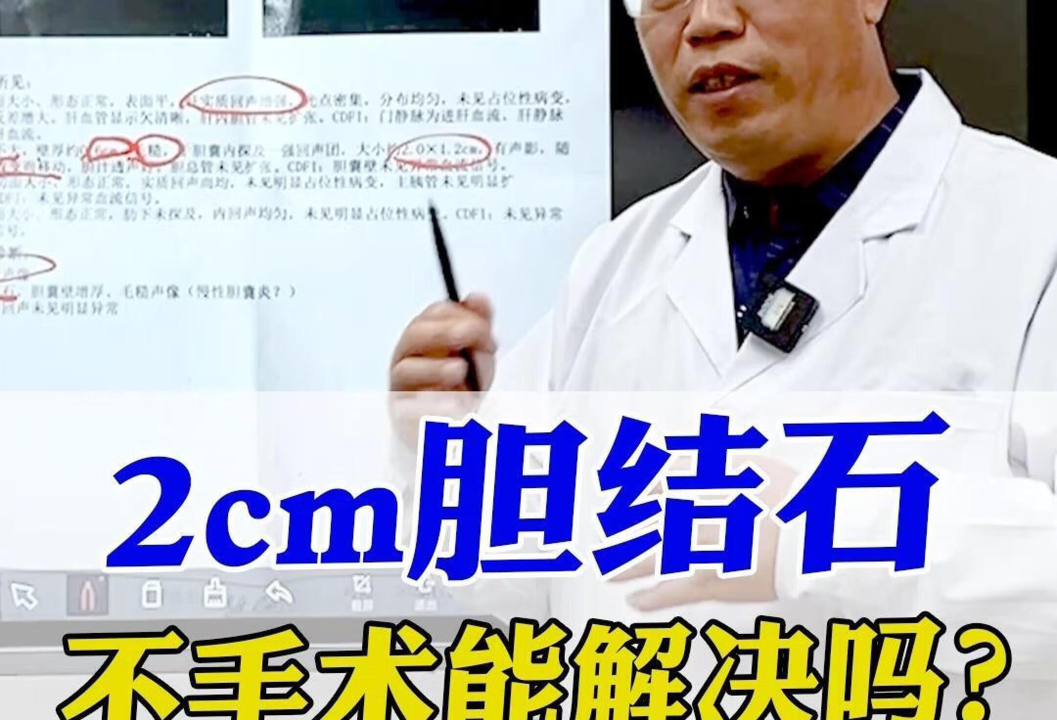 2cm胆结石，不手术能解决吗？这个方值得试