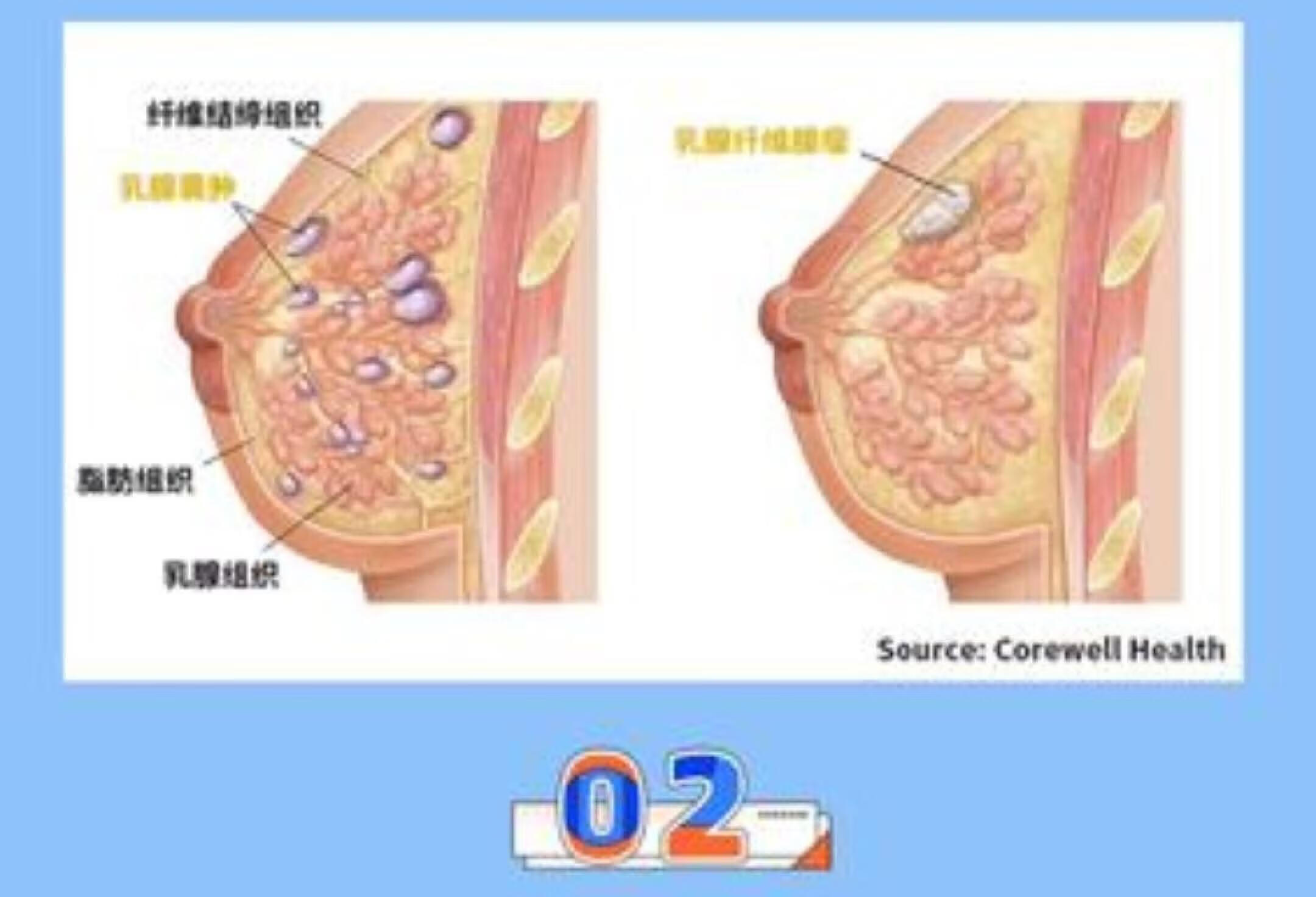 乳腺结节科普：你了解多少？