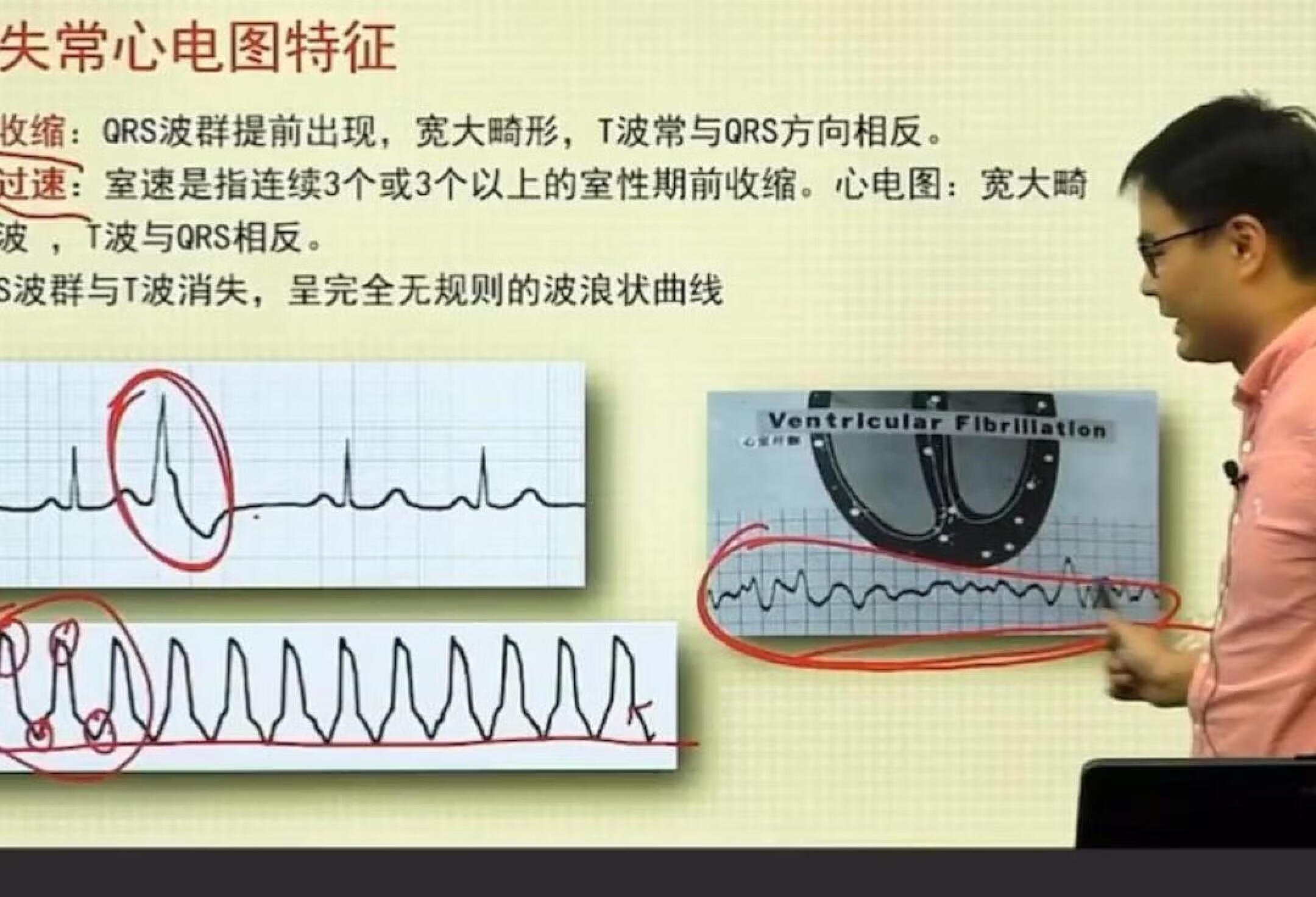 室性心动过速心电图特征