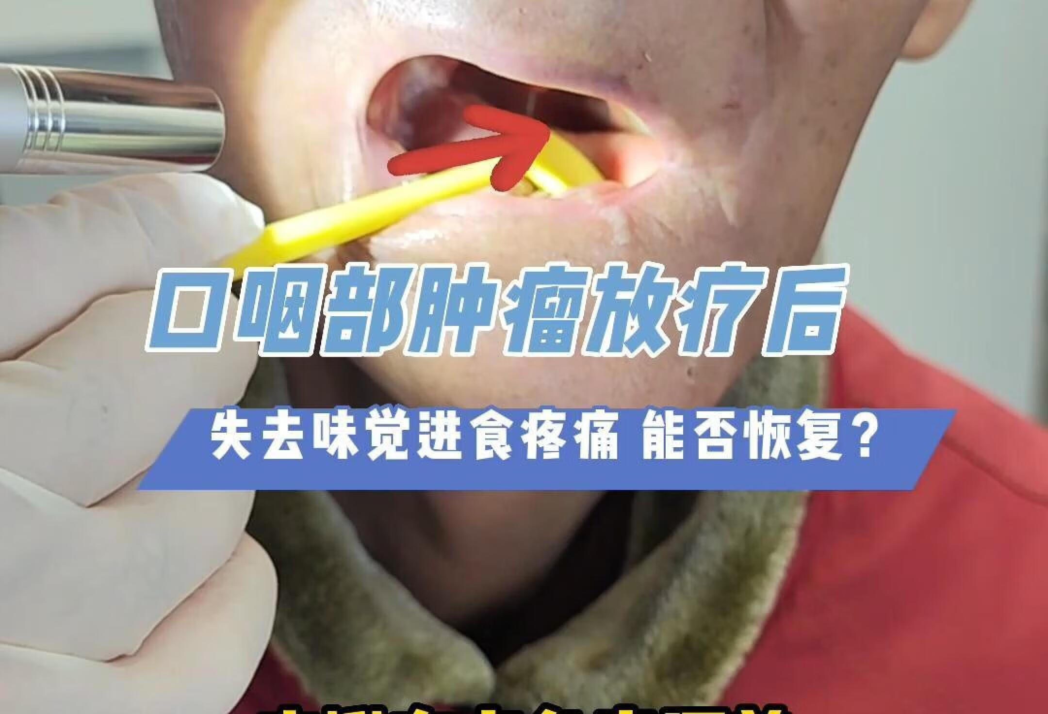 口咽部肿瘤放疗，进食疼痛无味觉，能恢复吗