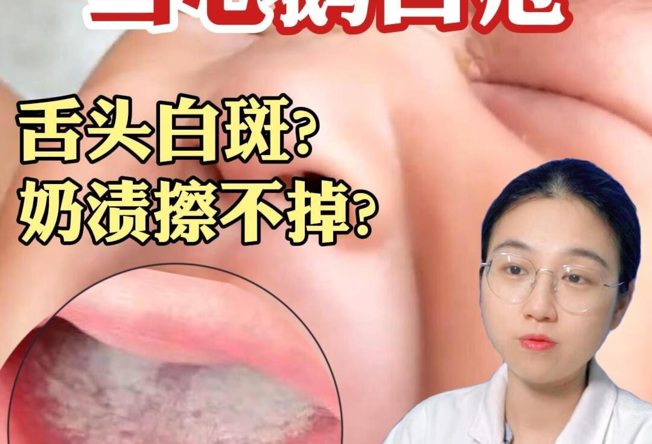 宝宝有鹅口疮怎么办⁉️医生教你2招搞定✅