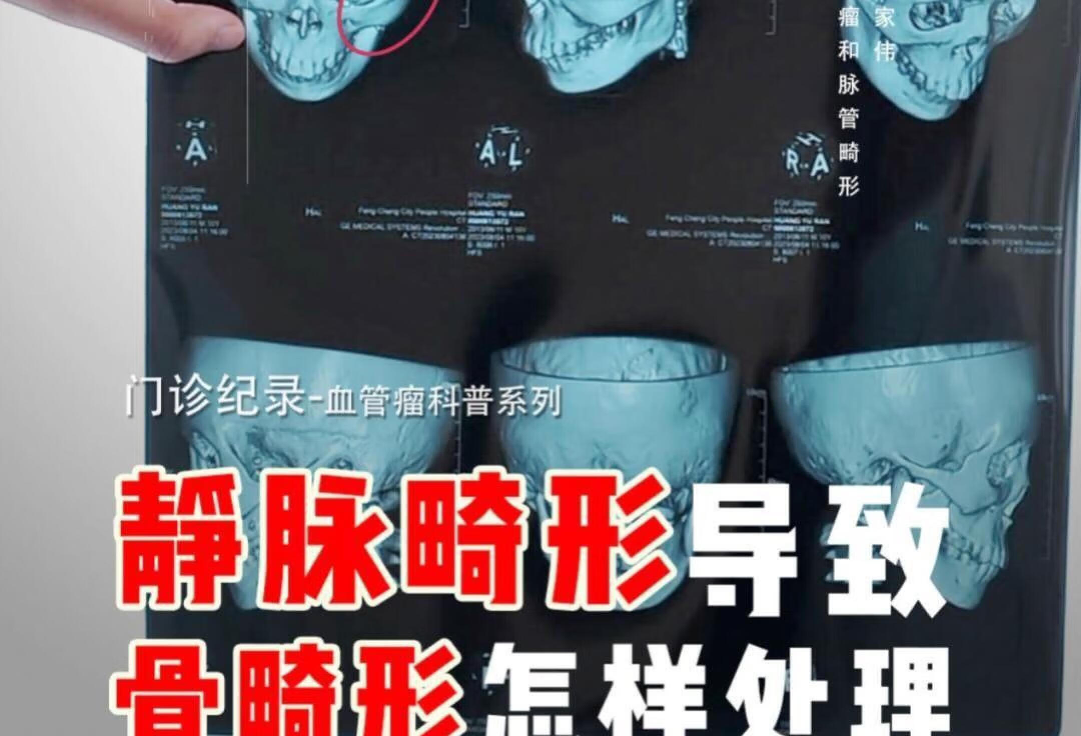 血管瘤导致骨畸形，什么时候处理最好？