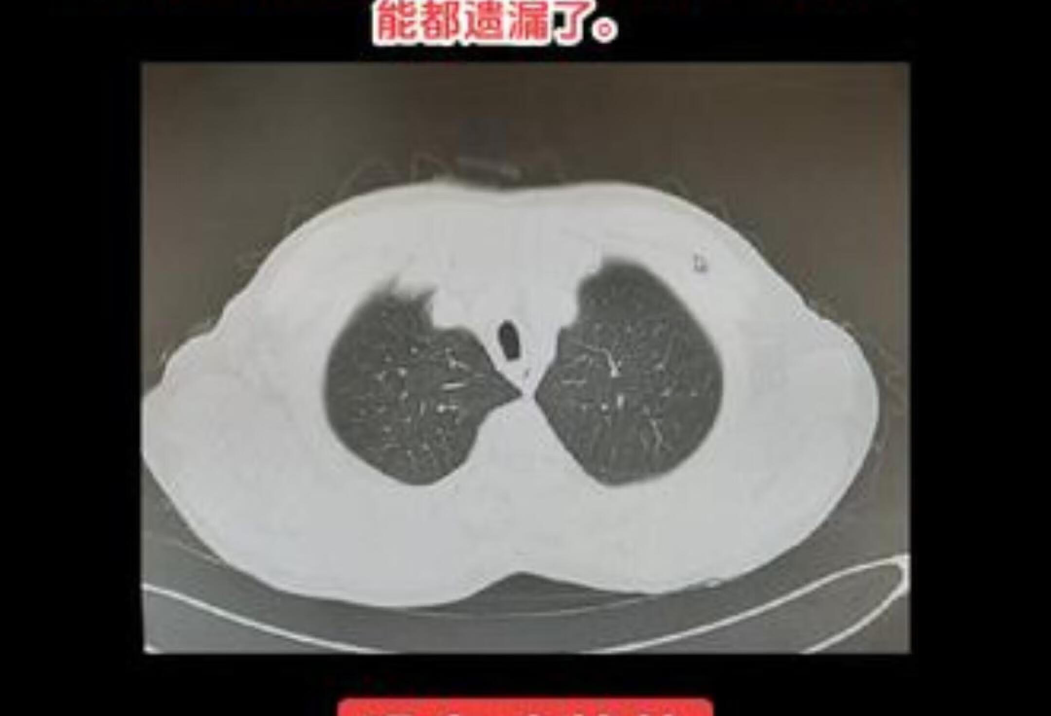 纵膈淋巴结肿大如何精准诊断？专业医学科普