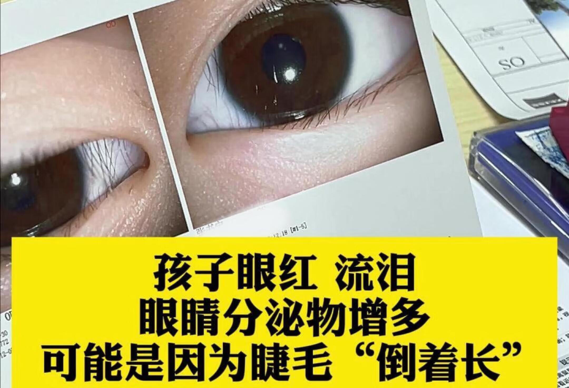 眼红流泪分泌物增多，可能是睫毛倒着长