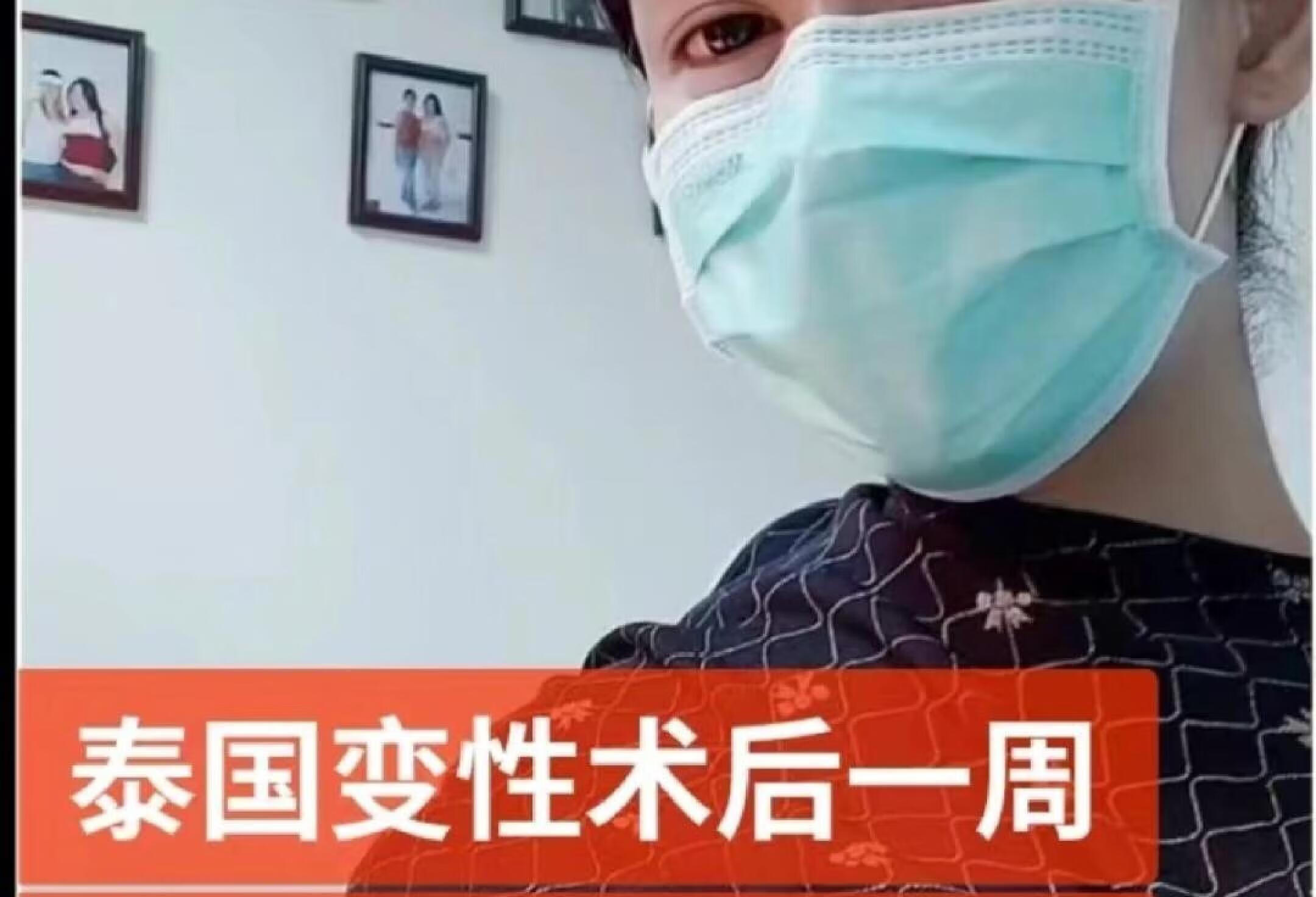 泰国变性一周拔管＋练习排尿＋使用模具好疼