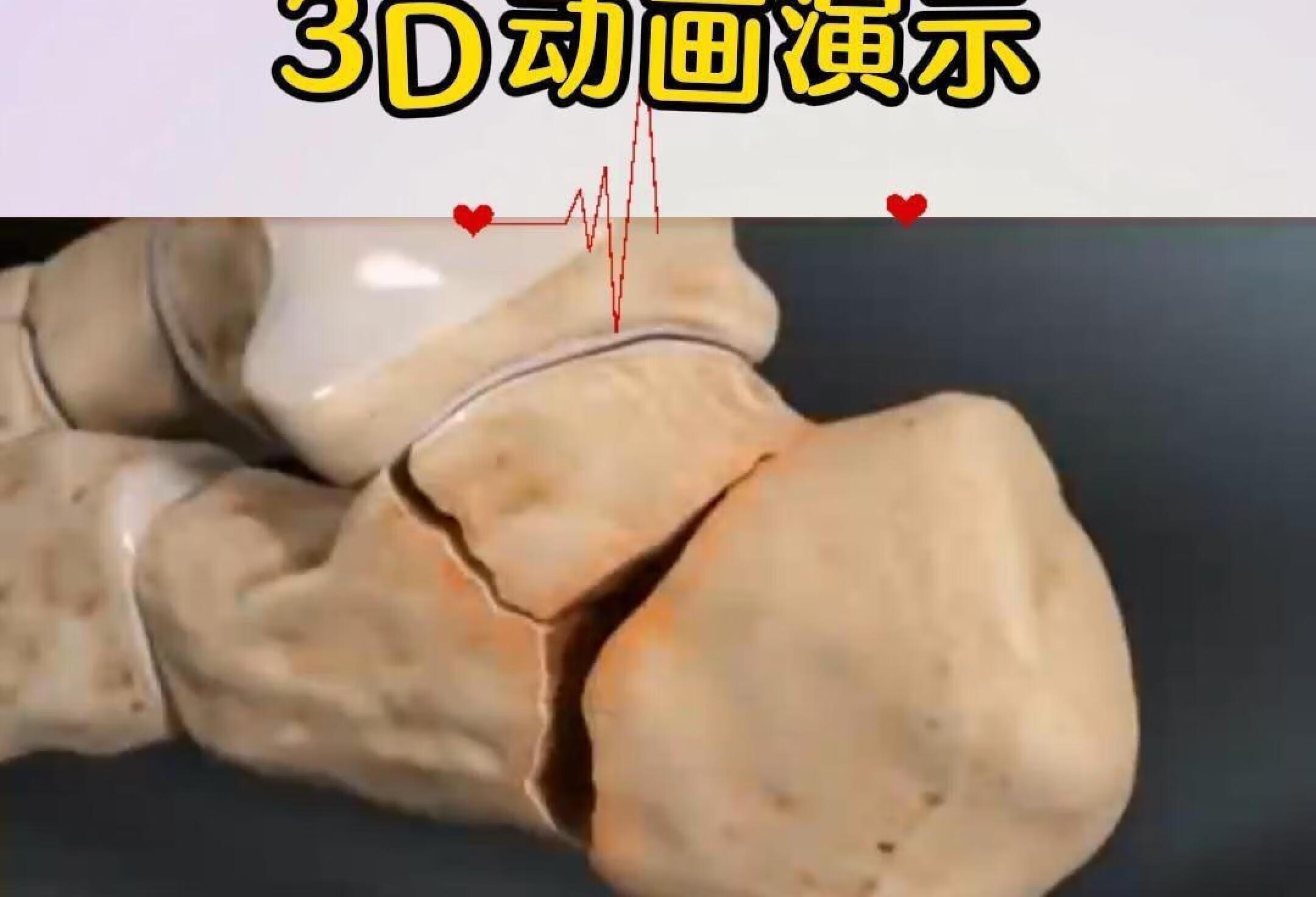 3D动画演示：跟骨骨折修复过程！