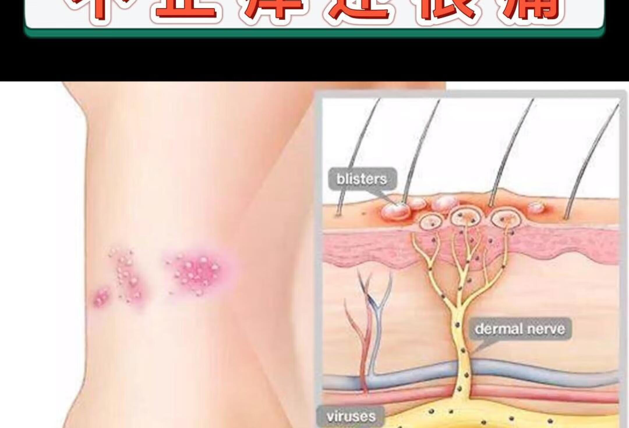 带状疱疹不止痒还很痛