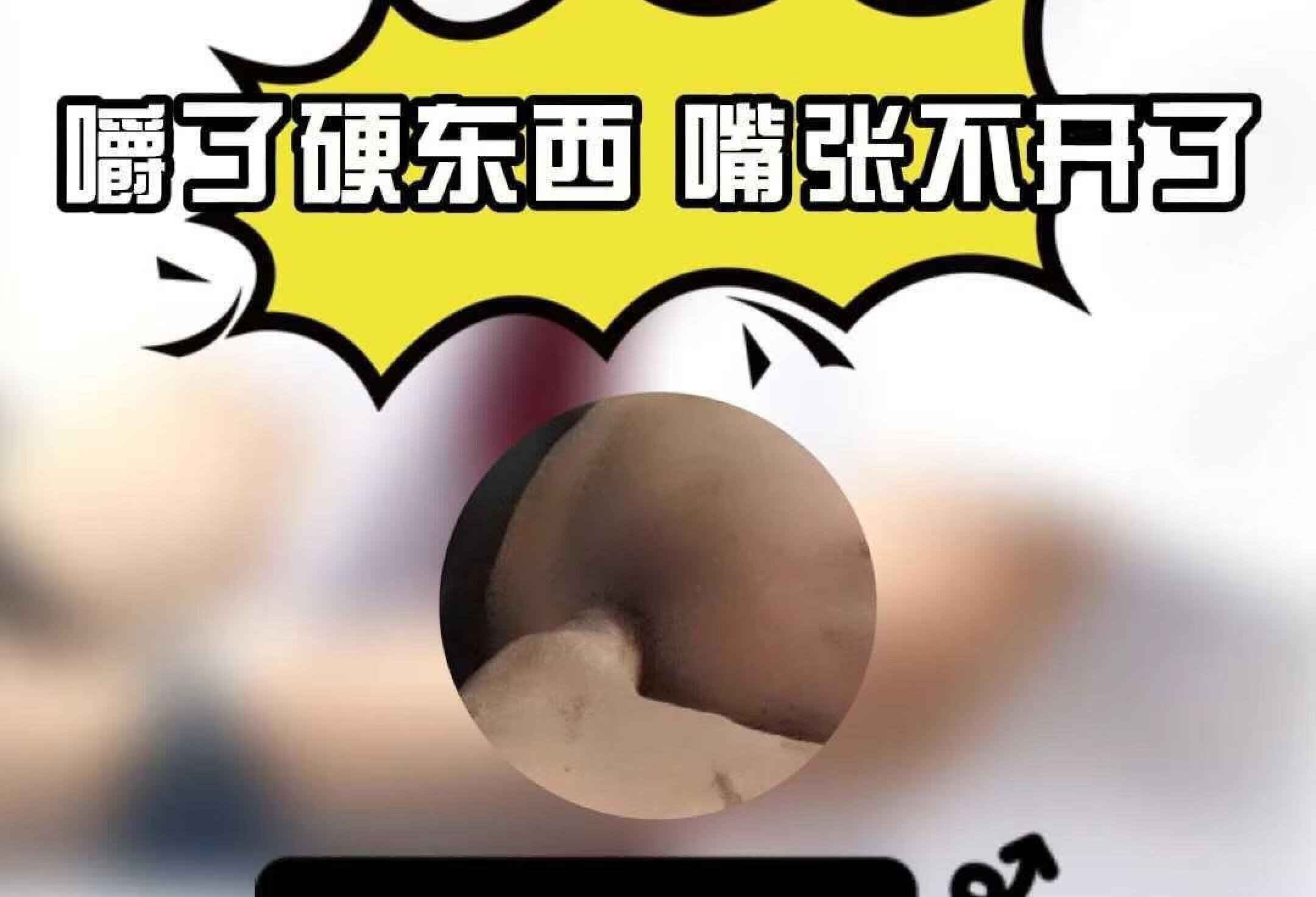 嚼了硬东西，嘴张不开了？