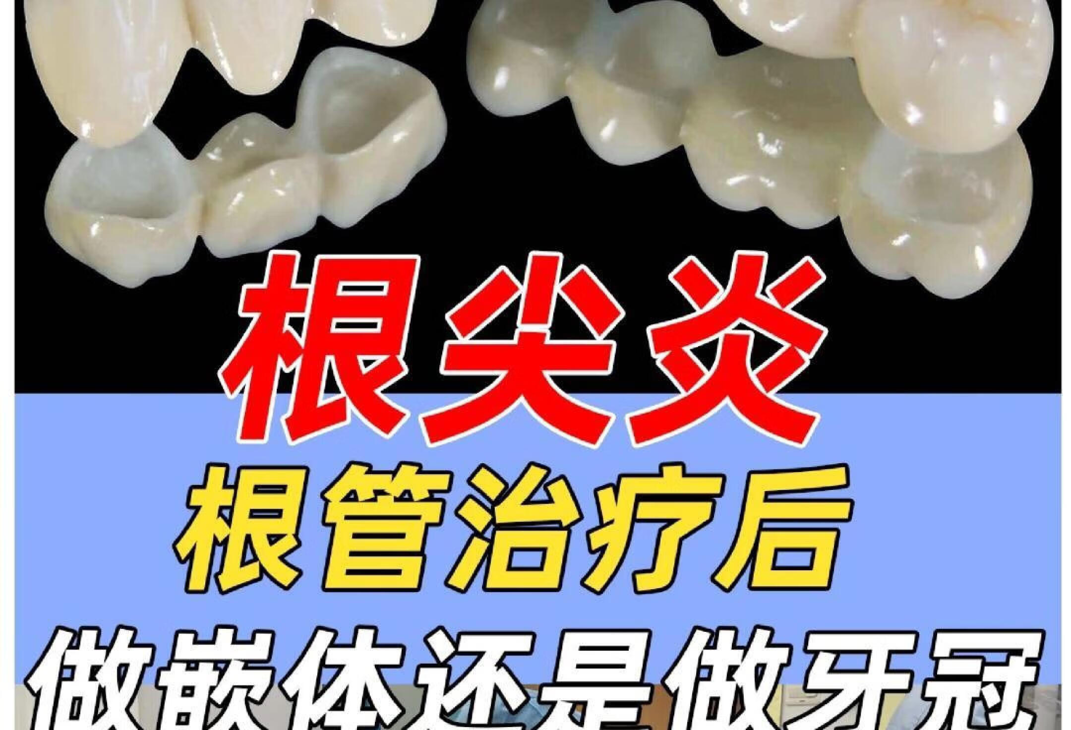 根尖炎，根管治疗后做嵌体还是牙套？