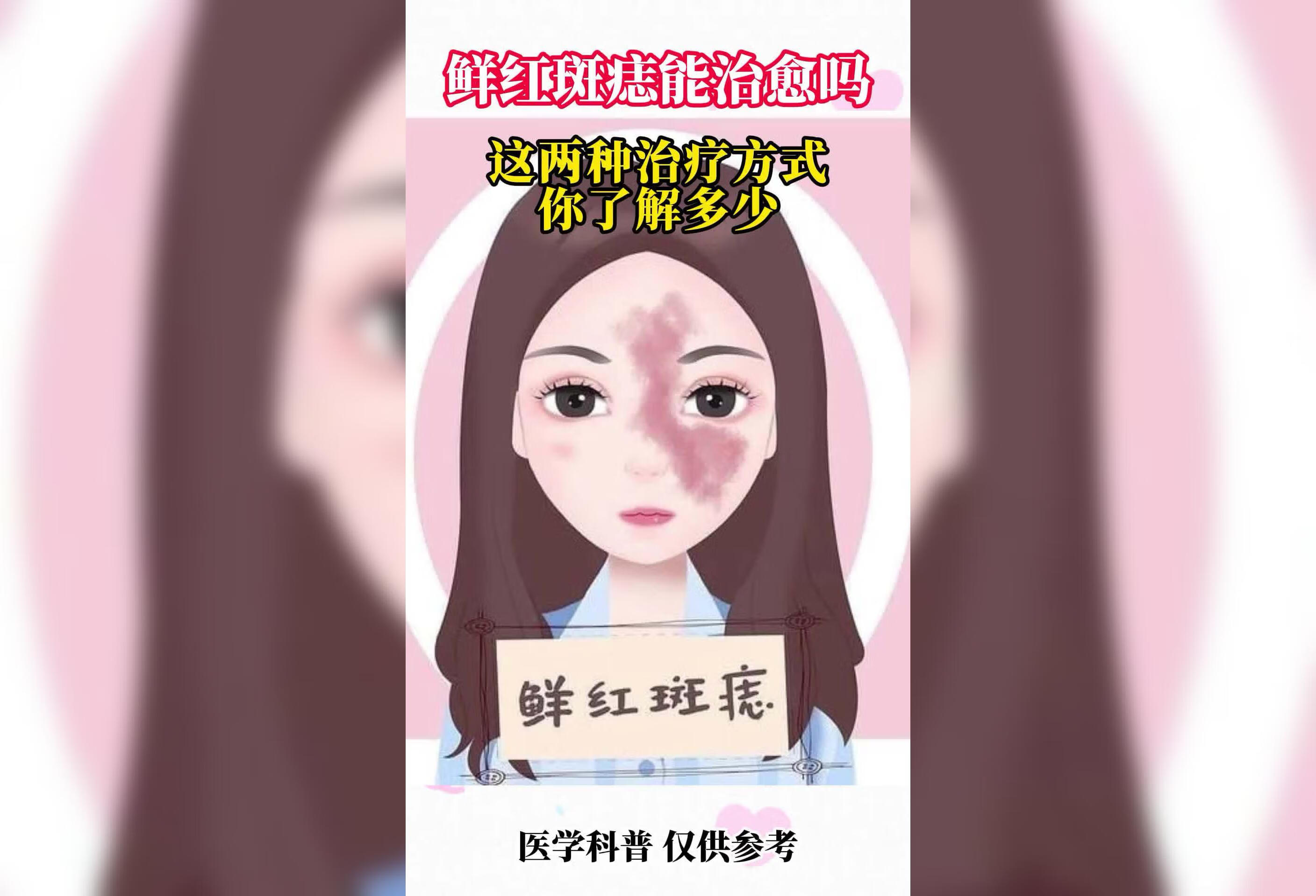 鲜红斑痣宝宝 