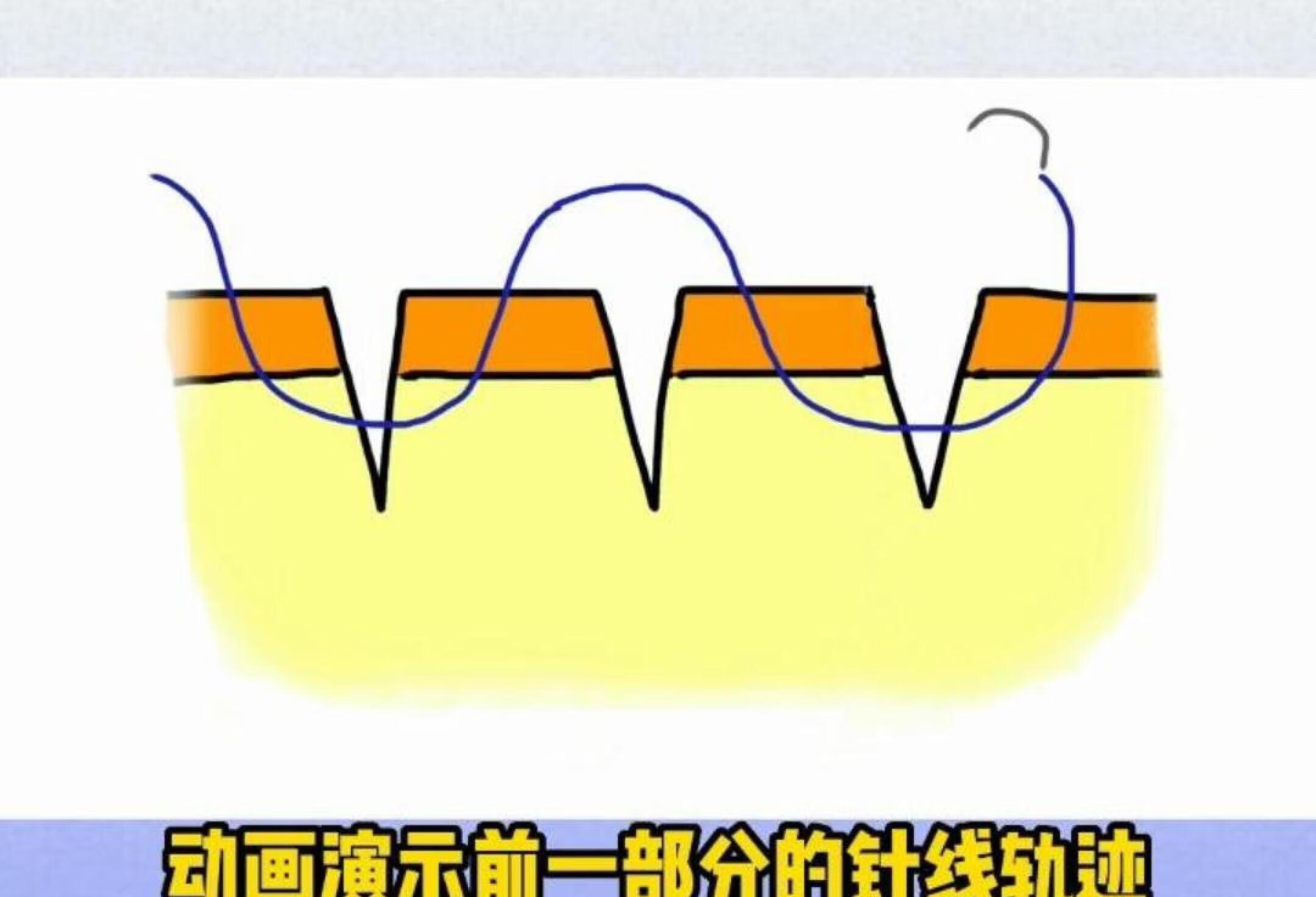 三条平行裂伤的缝合方法