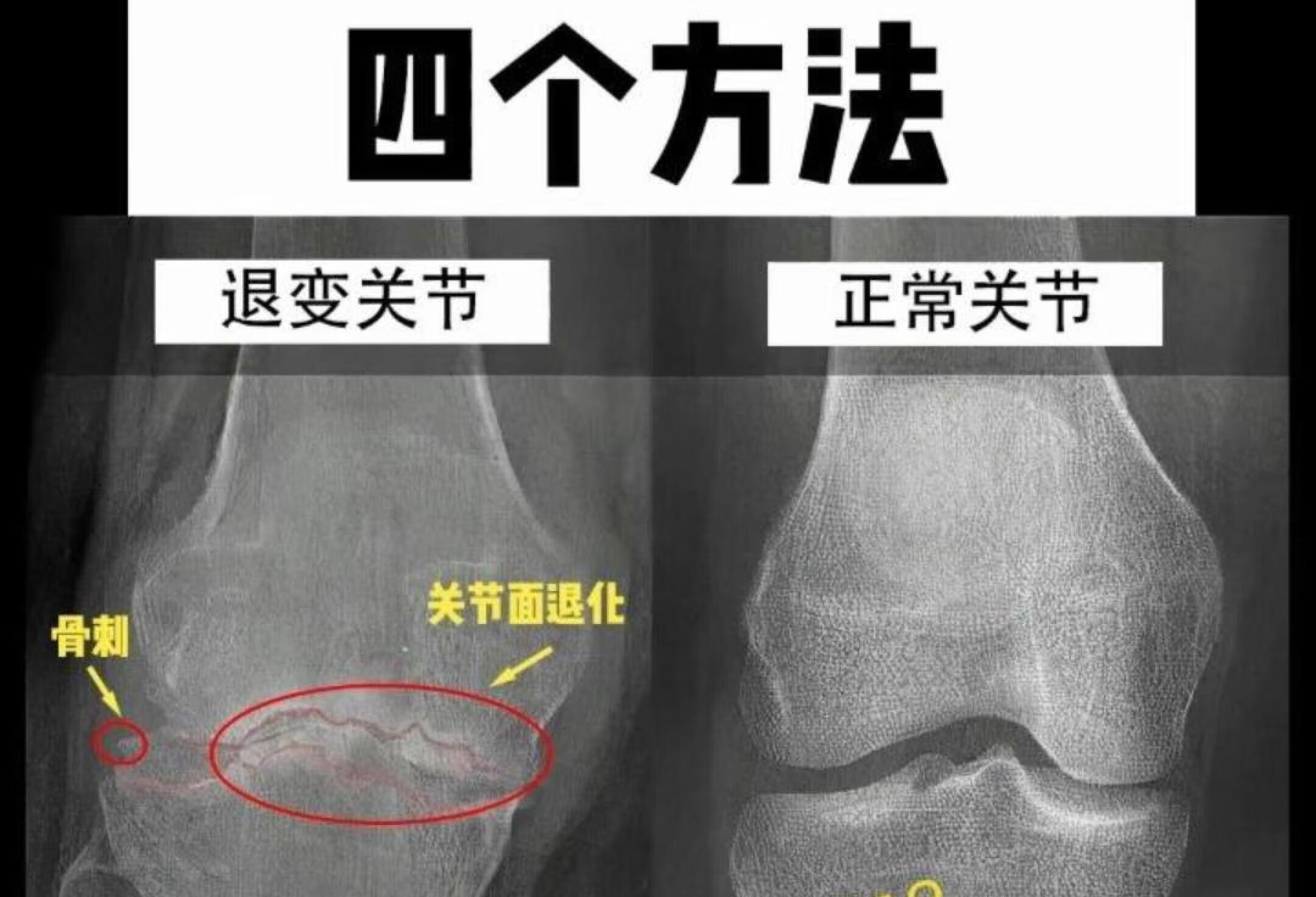 简单测试一下你膝盖的健康状况