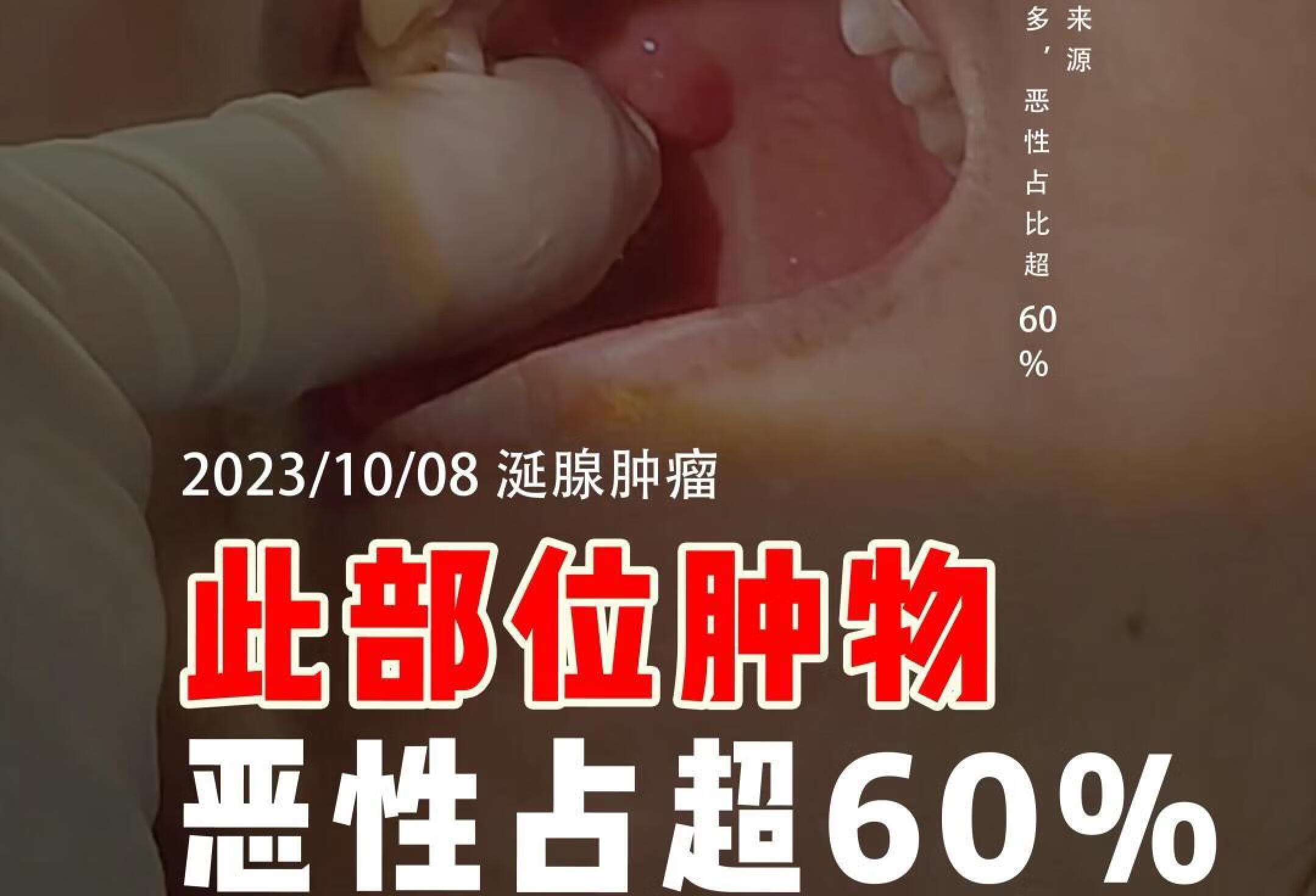 腭部肿物来源小唾液腺较多，恶性占比超60%