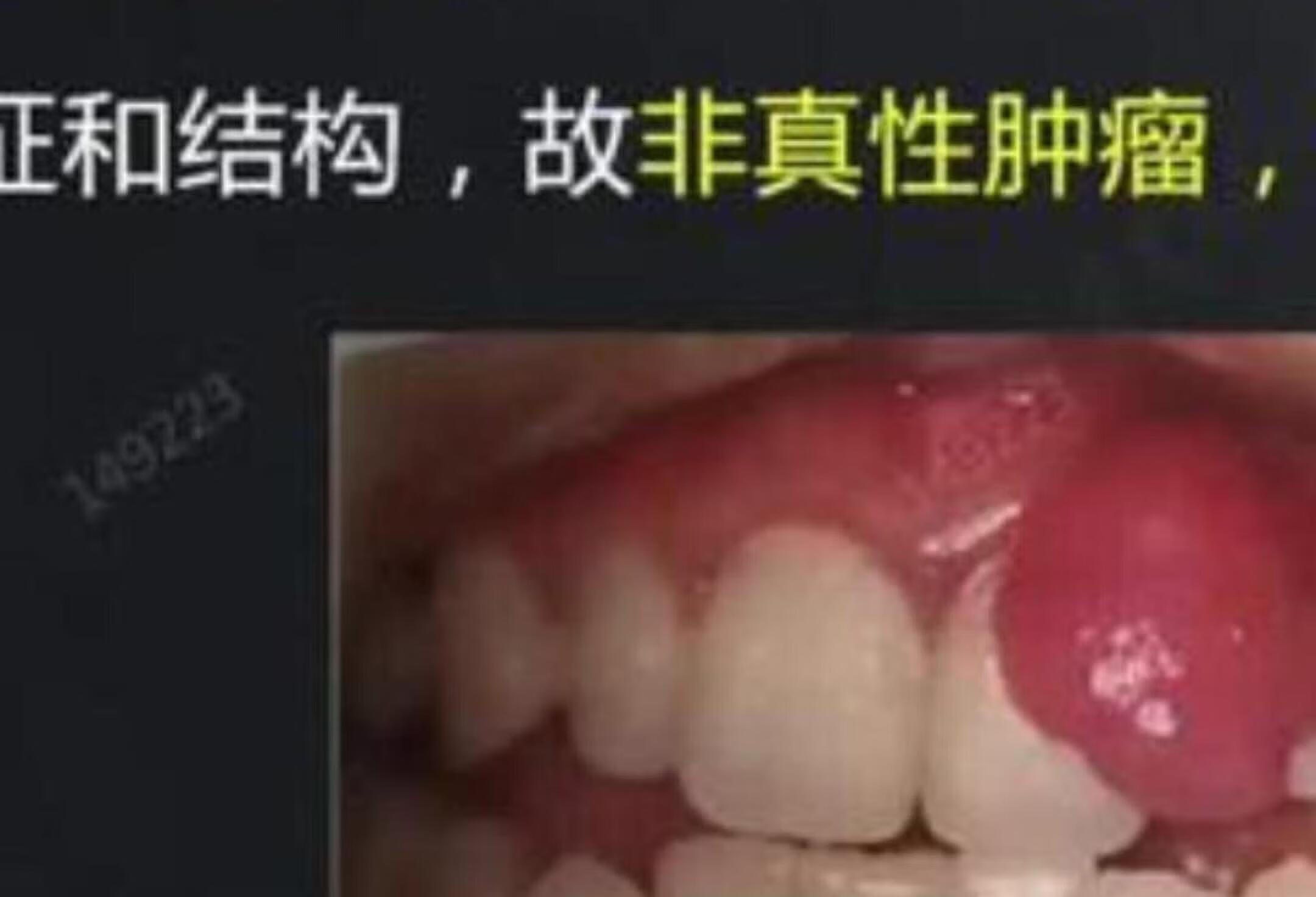 牙龈瘤考点解析，口腔医师必看