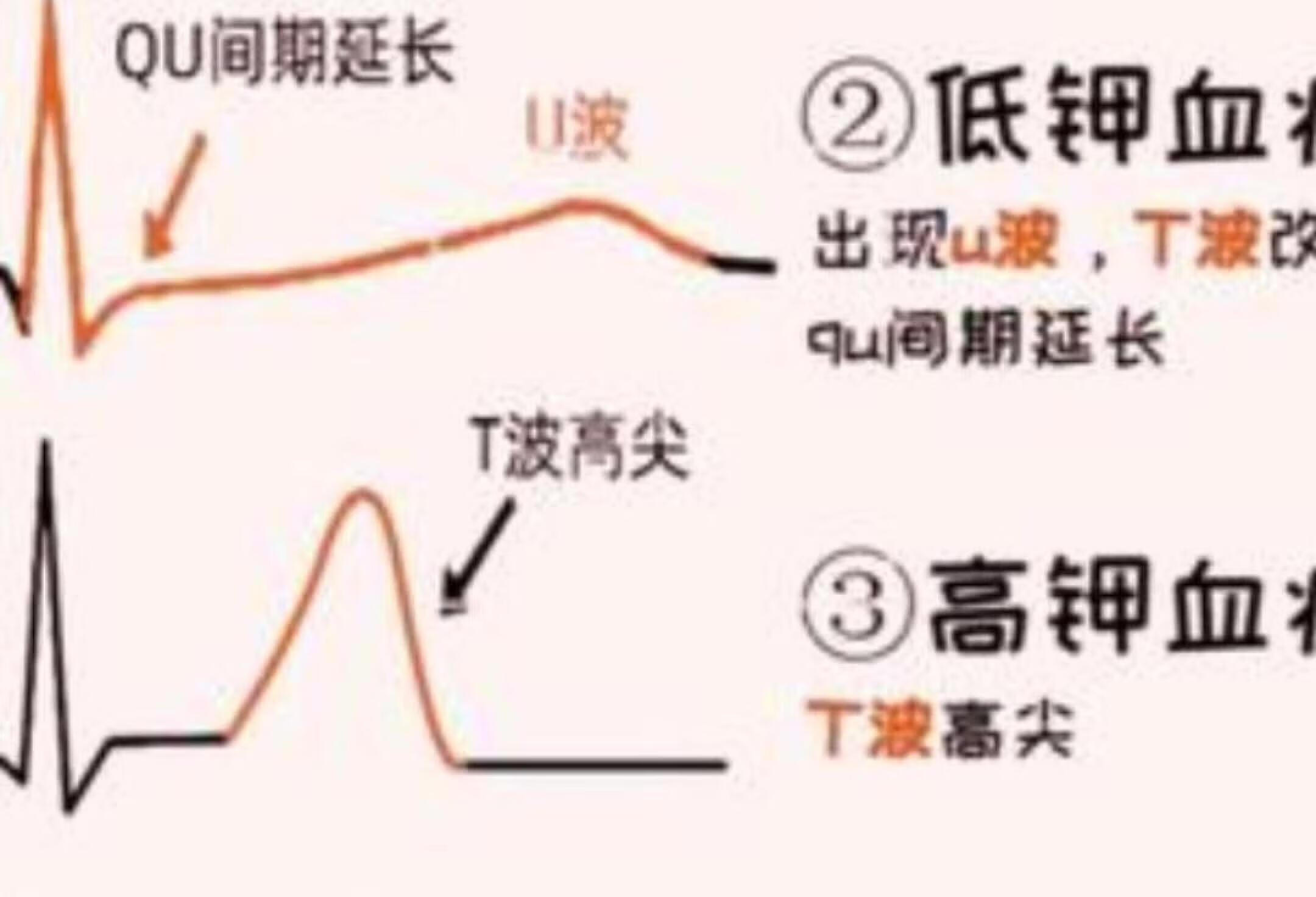 电解质紊乱的心电图解析：护士必学