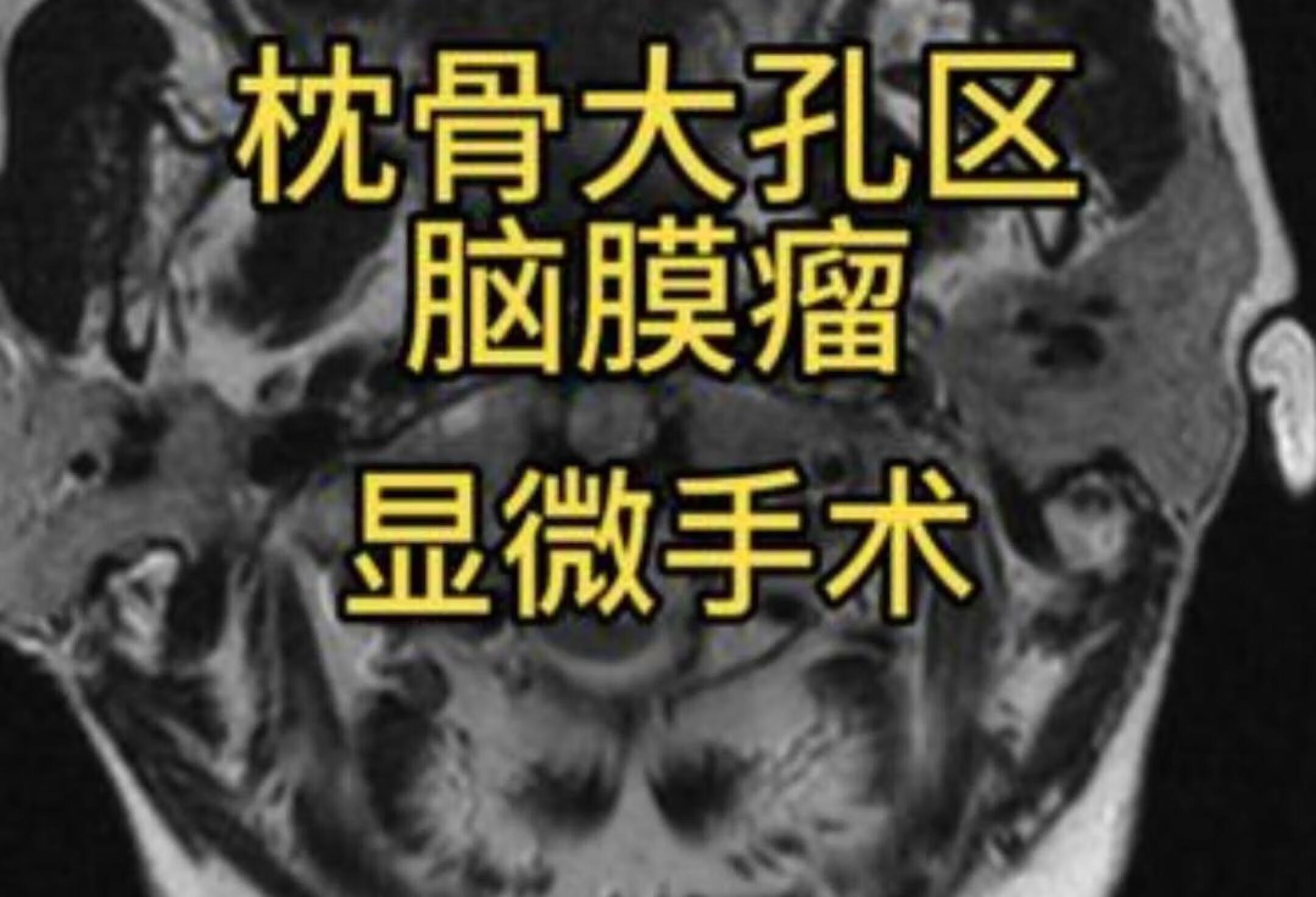 脑膜瘤显微手术揭秘医生日常