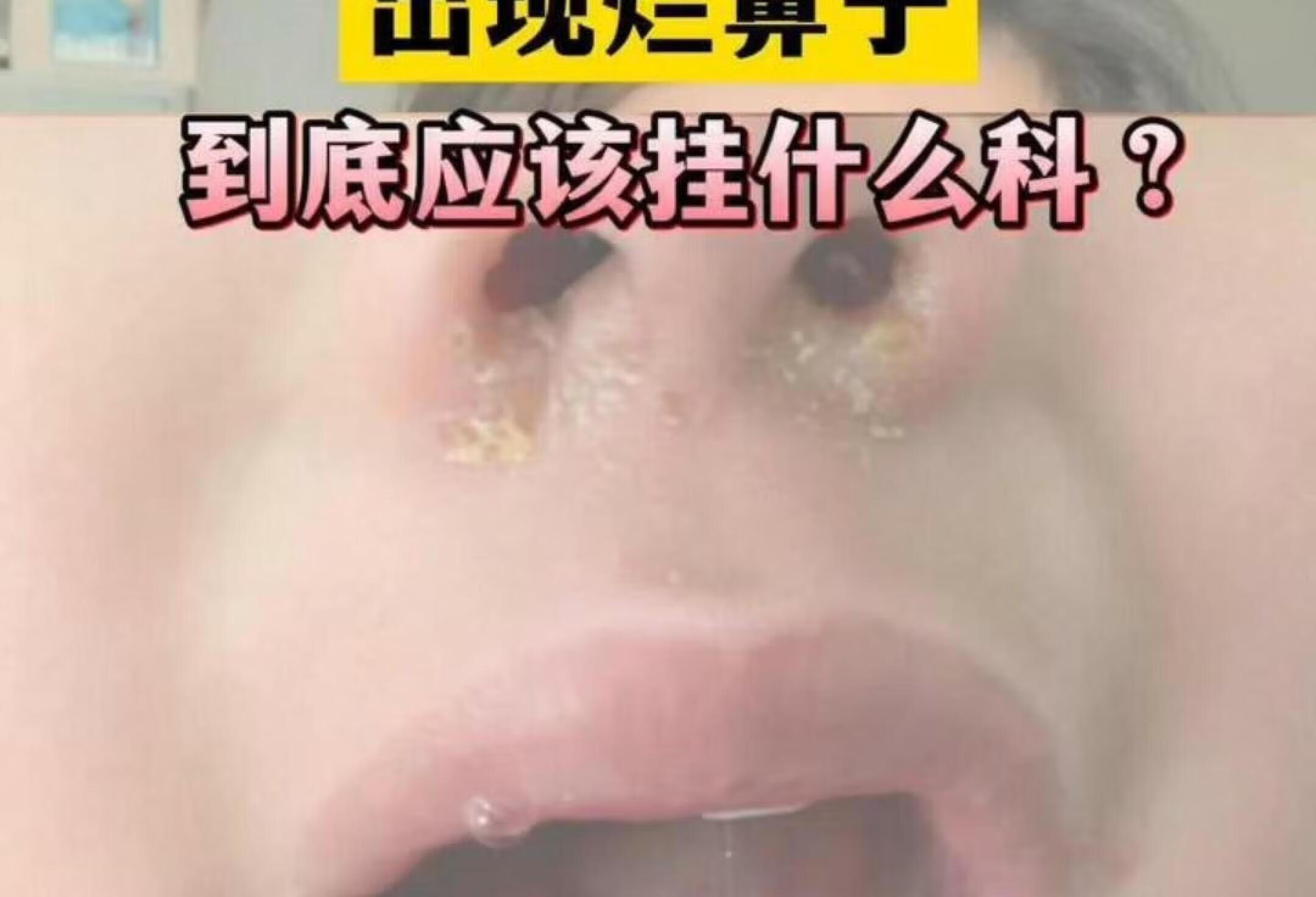 孩子烂鼻子应该挂什么科？