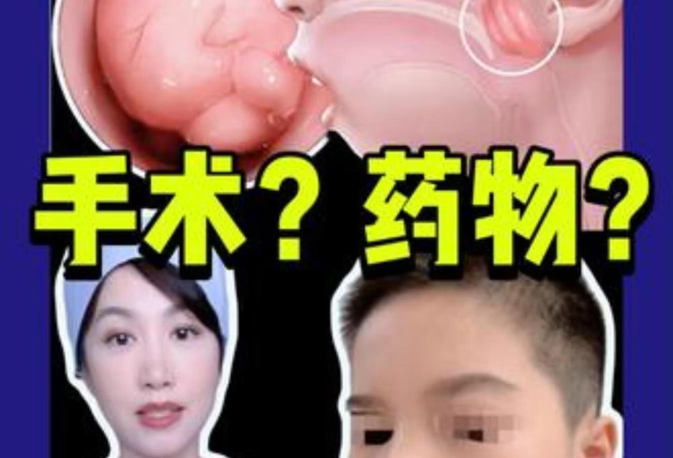 腺体肥大 中药有效吗？ 权威健康解答