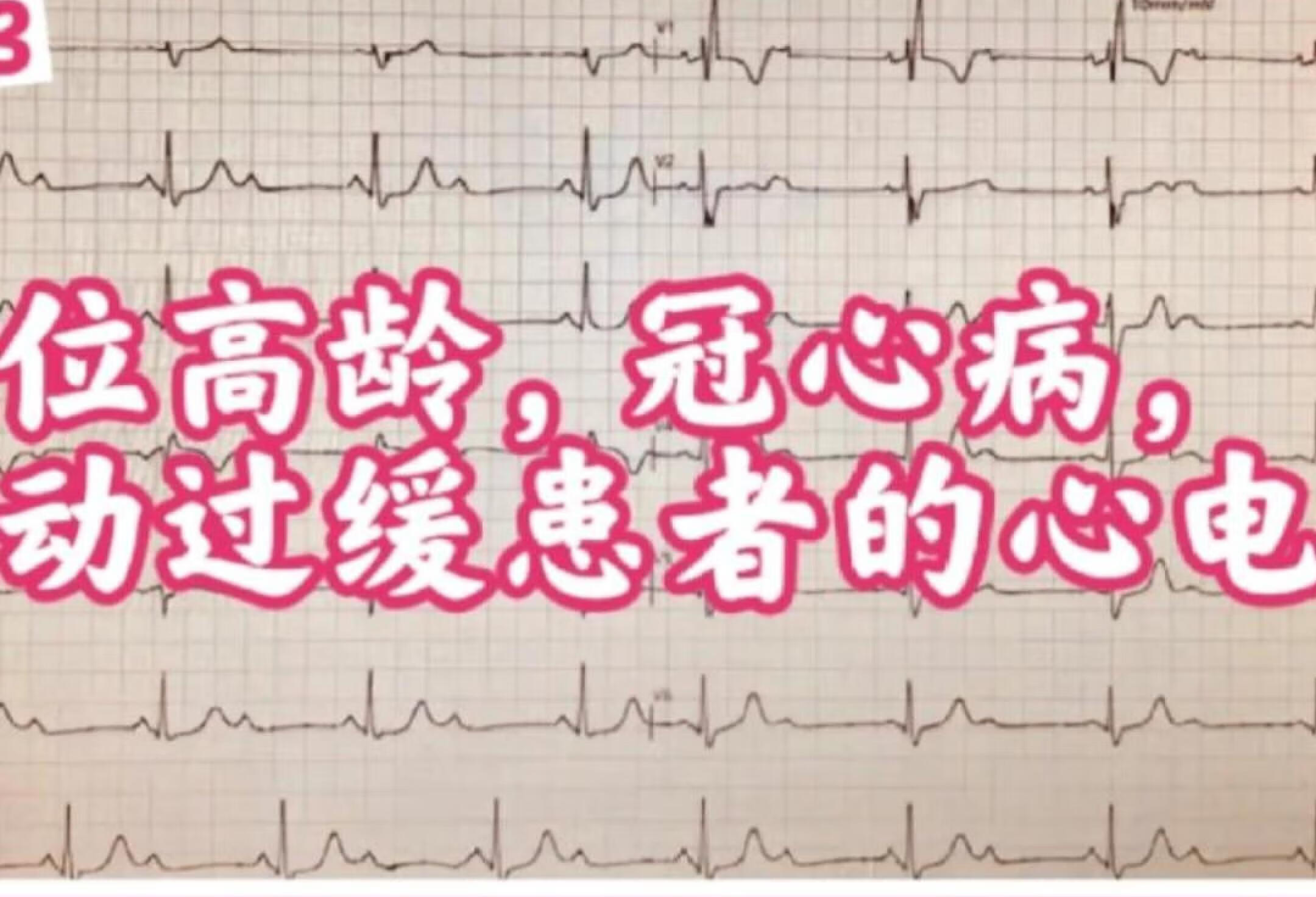 一位冠心病心动过缓高龄患者的心电图学习