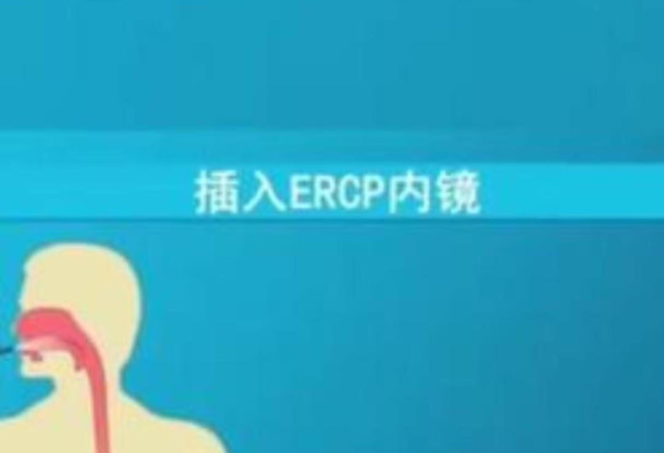 胆总管结石也可以微微创内镜取出～ERCP胆总管结石