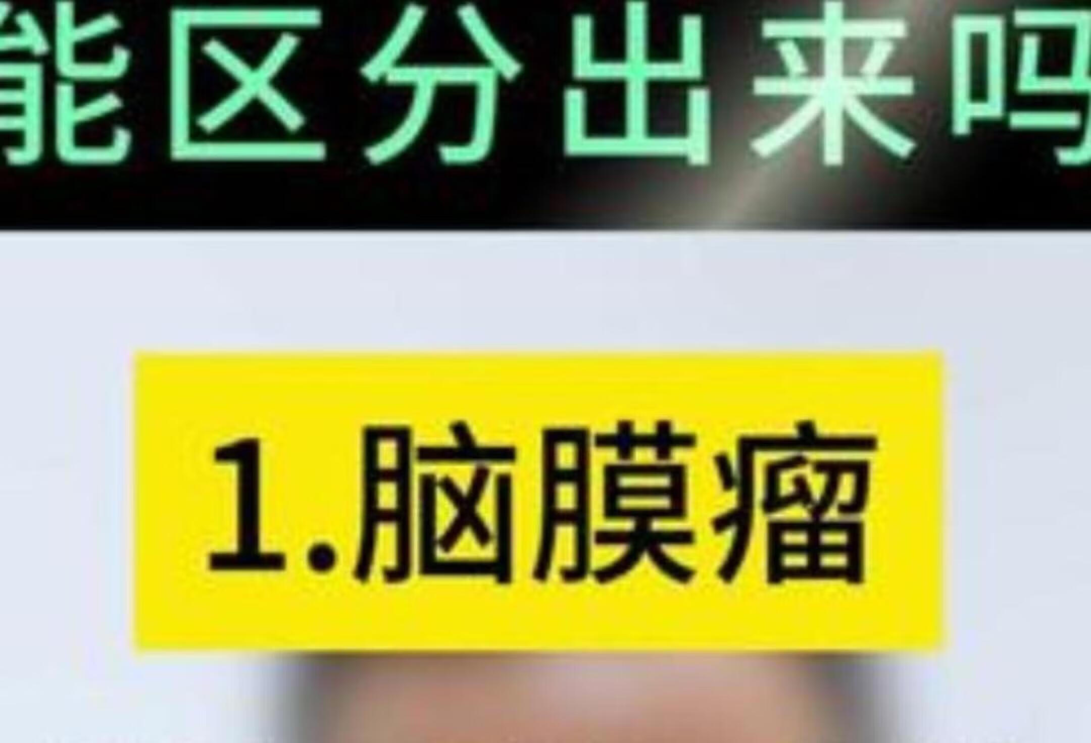 伽玛刀专家教你识别5种脑瘤症状