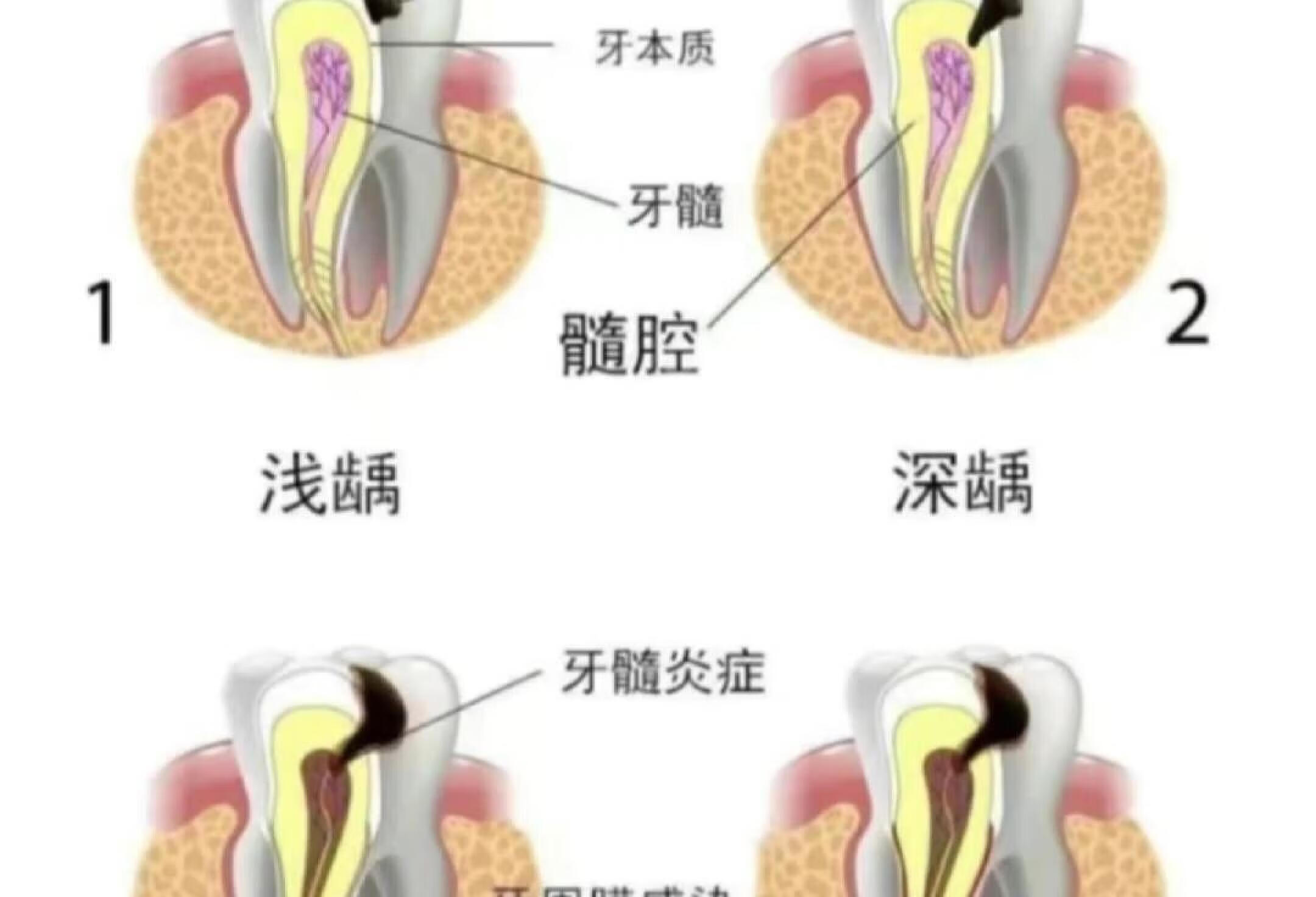 宝宝乳牙蛀牙，到底是等换牙还是及时补牙？