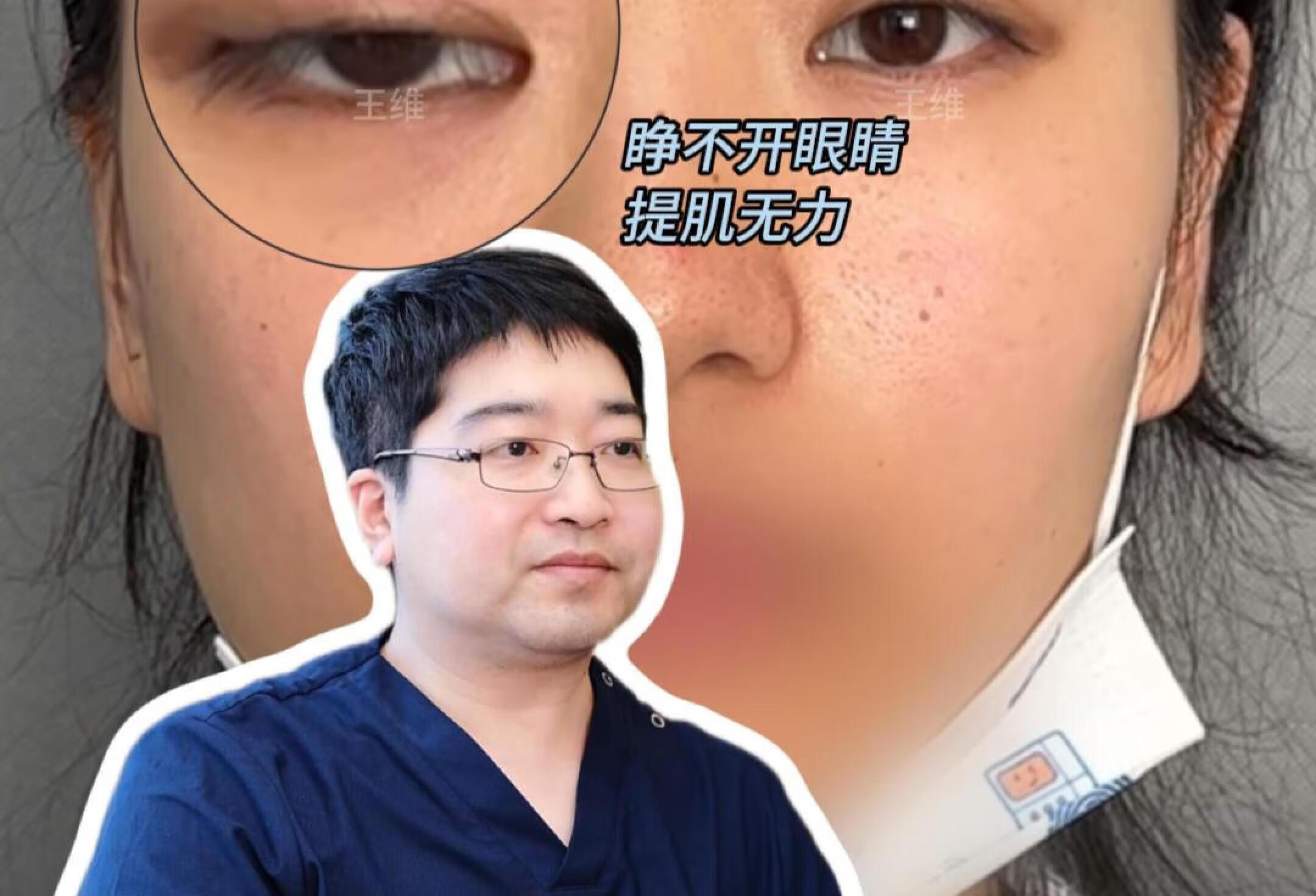 上睑下垂矫正手术需要住院吗❓