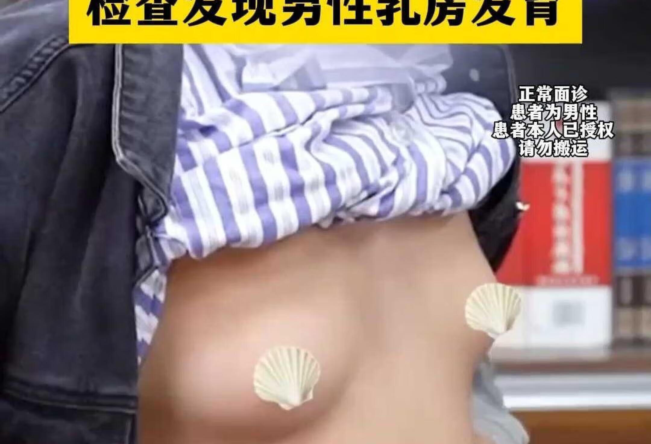 男性乳腺发育症