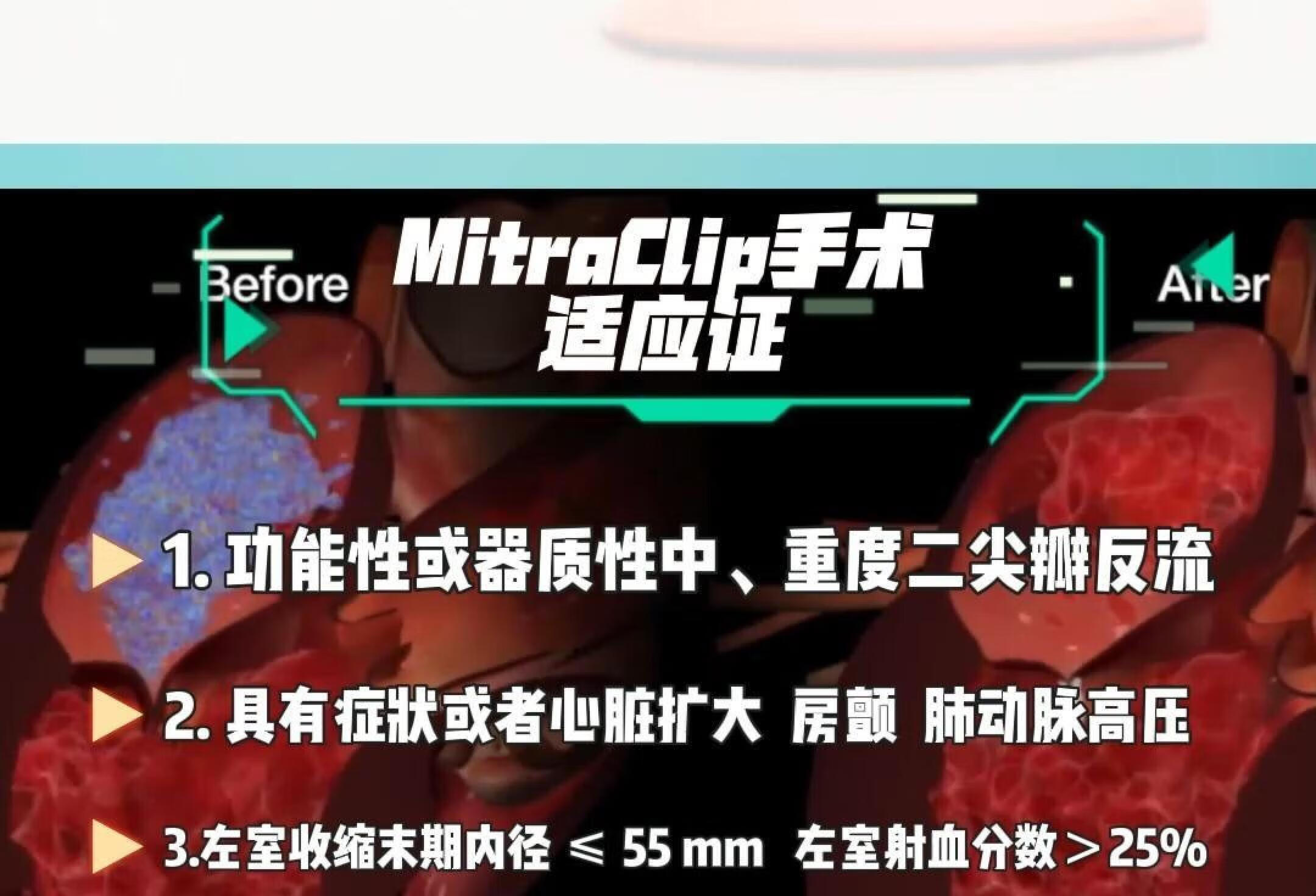 MitraClip手术经导管二尖瓣钳夹术