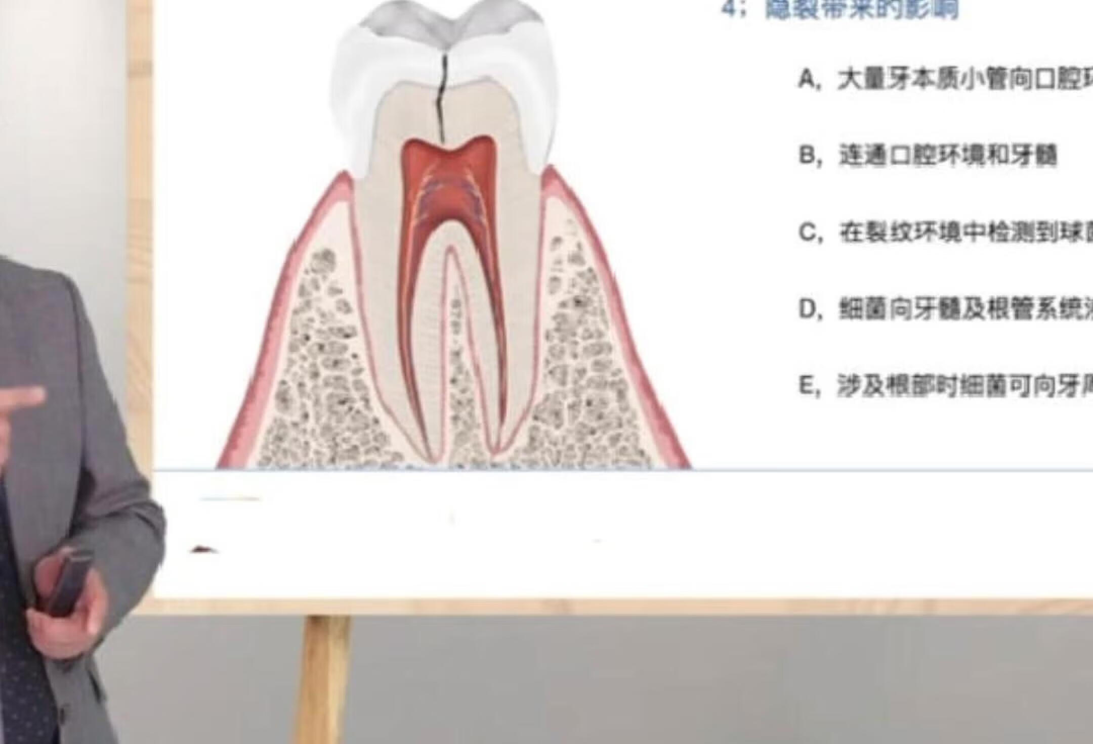 周锐【活髓牙隐裂的粘接修复方案 】第二段