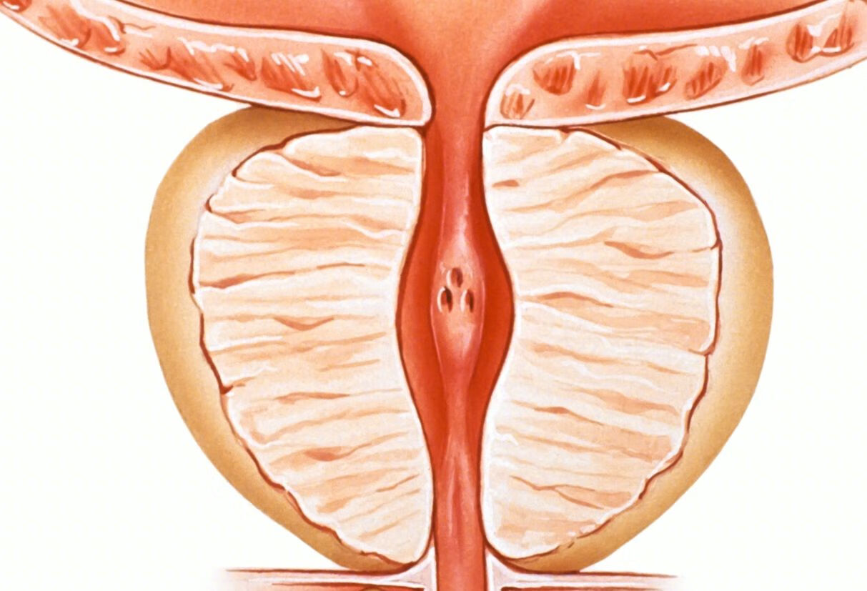 前列腺癌会有哪些症状？
