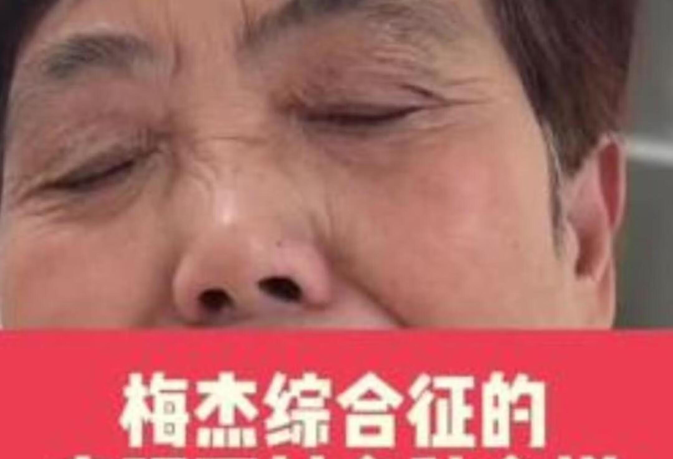 梅杰综合征：眼睑痉挛和肌张力障碍详解