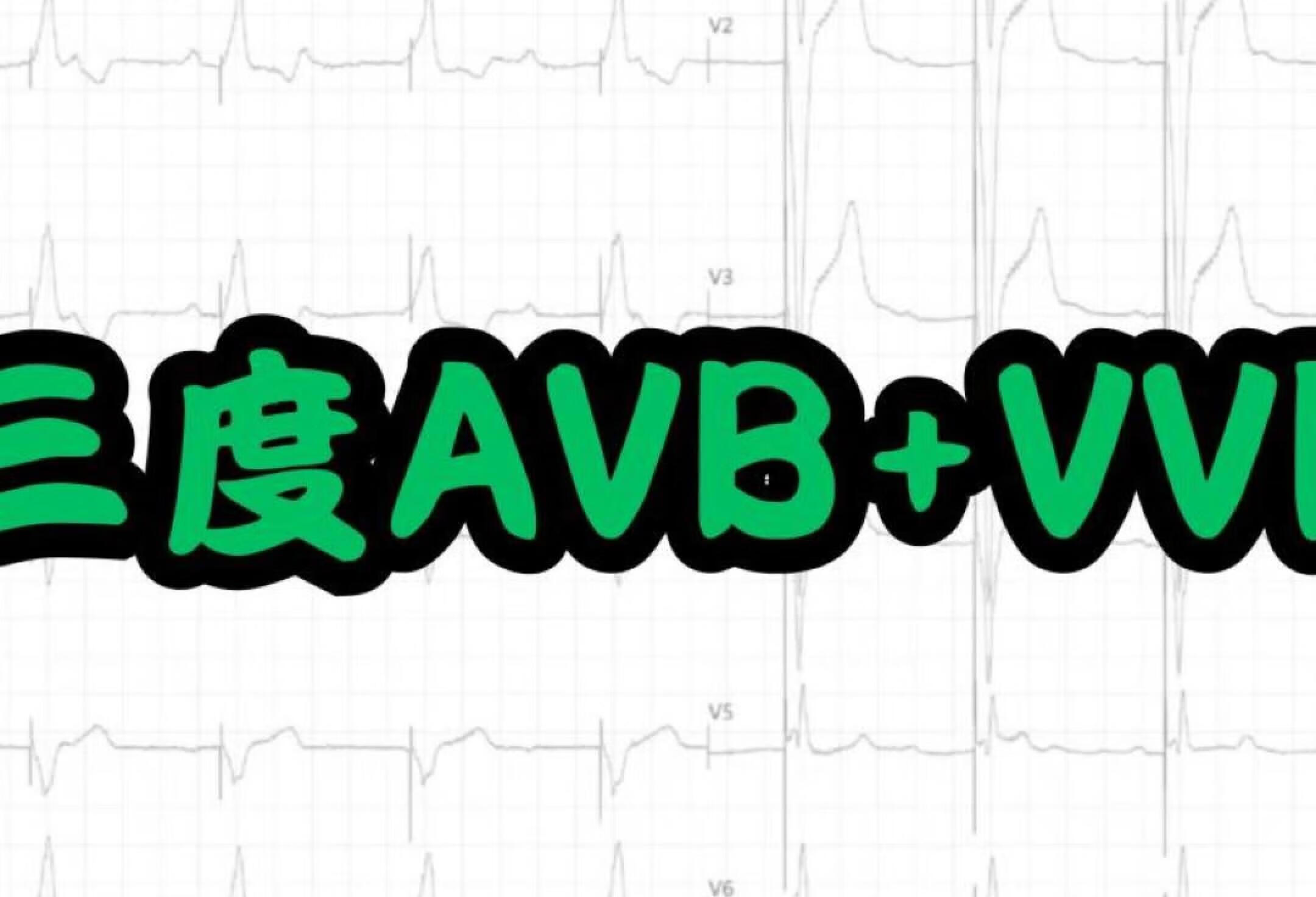 心电图病例--三度AVB+VVI