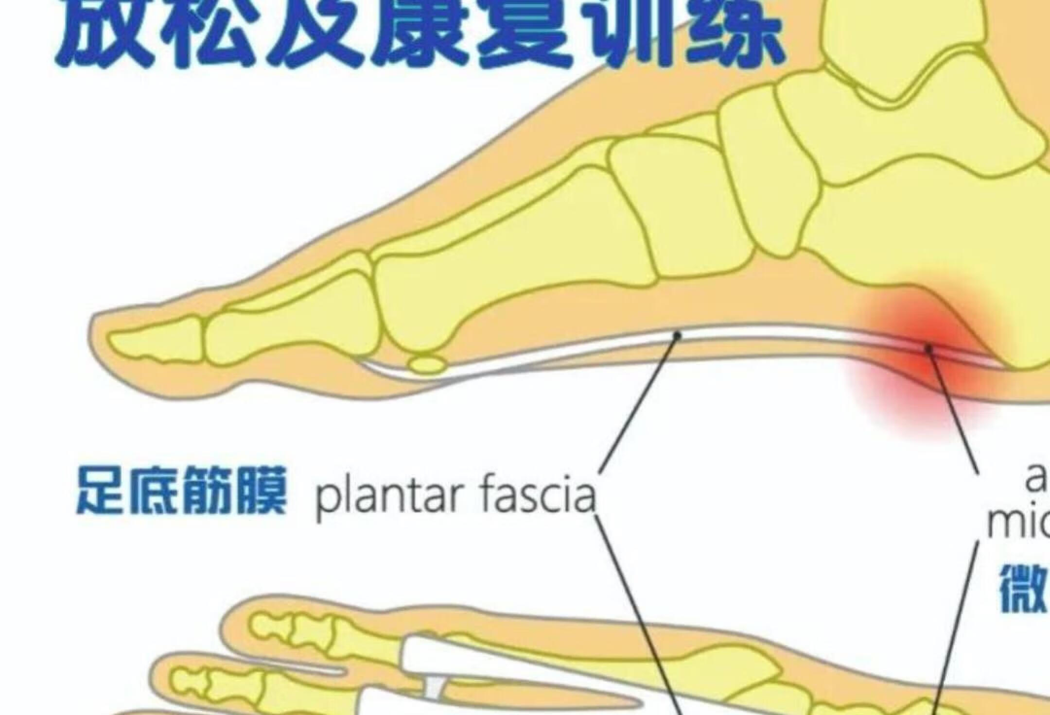 足底肌膜炎的福音