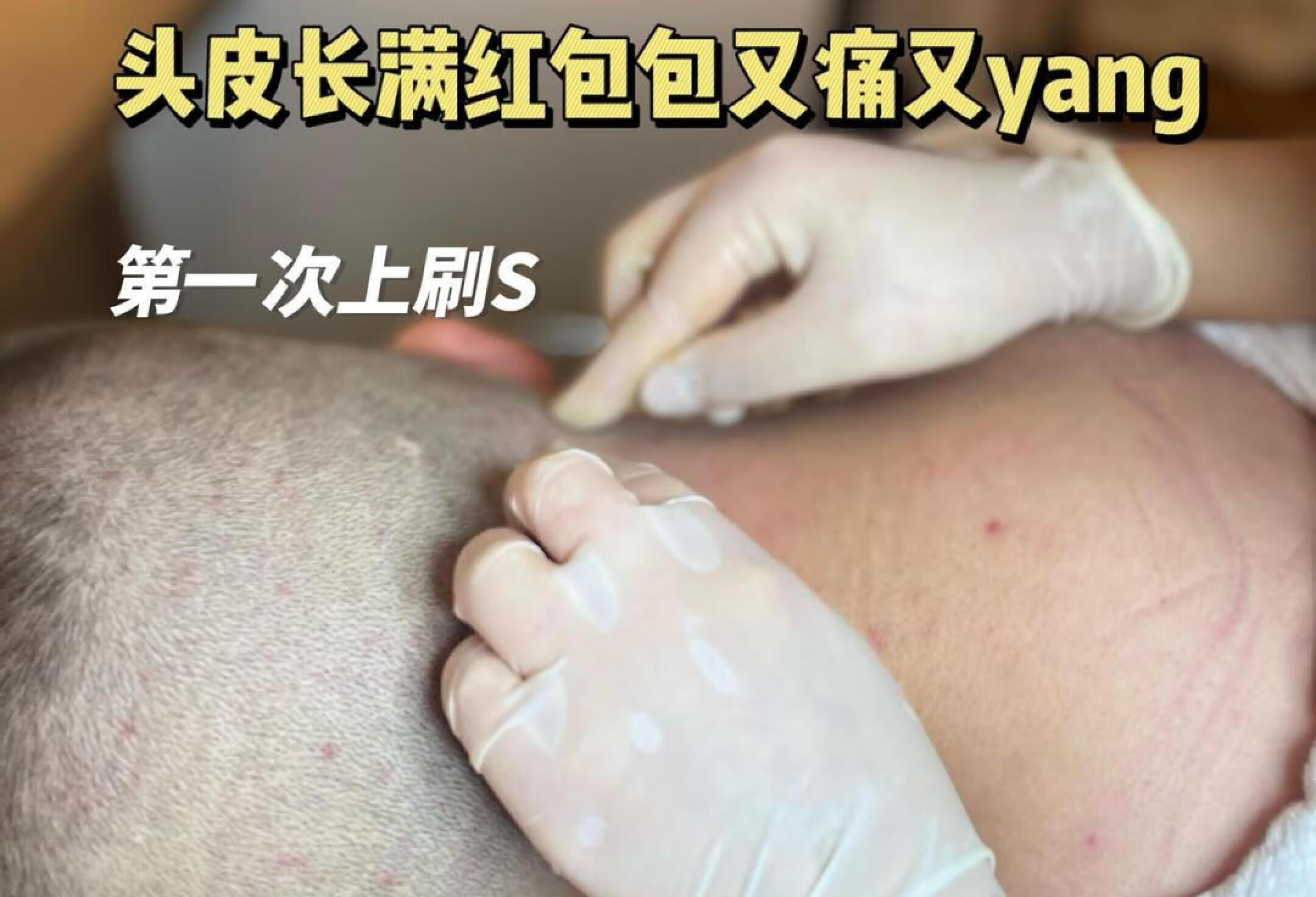 豆豆长满头皮的17岁小男孩